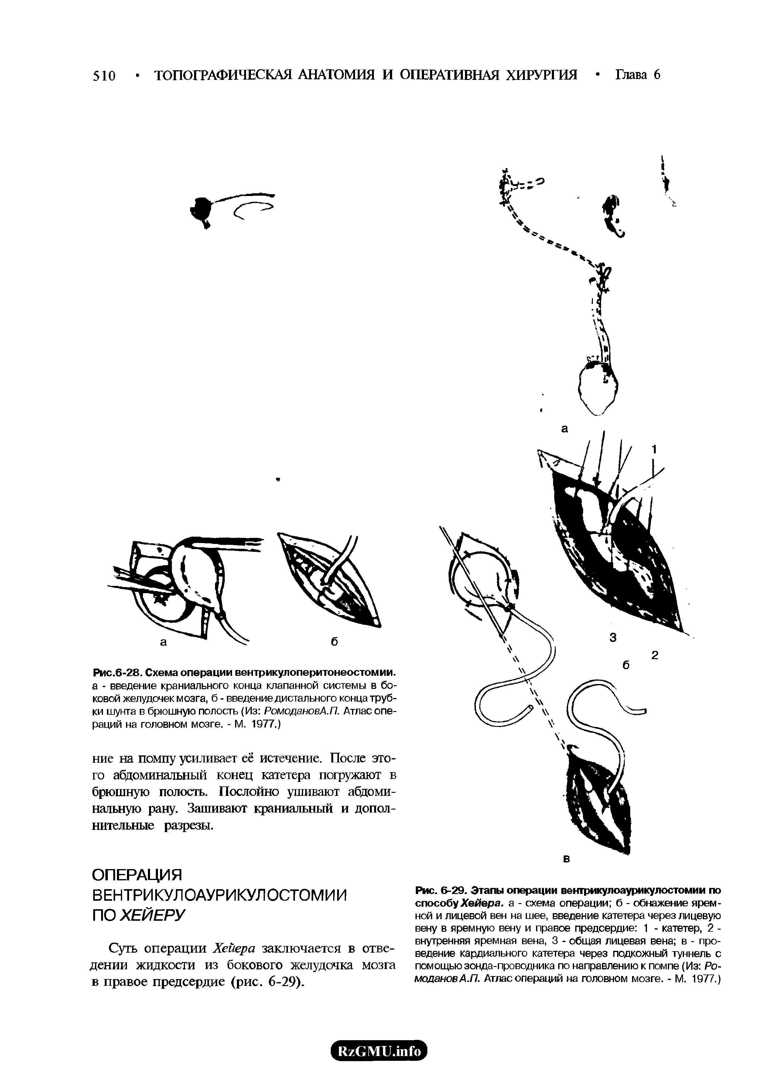 Рис.6-28. Схема операции вентрикулоперитонеостомии, а - введение краниального конца клапанной системы в боковой желудочек мозга, б - введение дистального конца трубки шунта в брюшную полость (Из РомодановА.П. Атлас операций на головном мозге. - М. 1977.)...