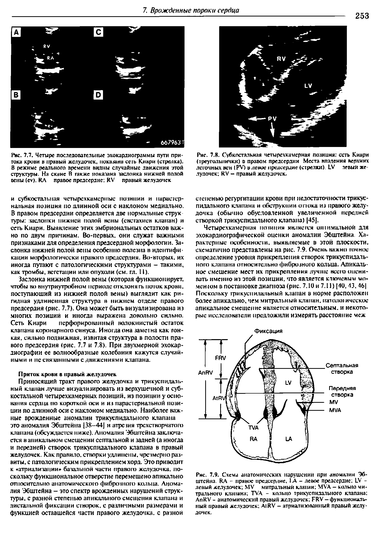 Рис. 7.7. Четыре последовательные эхокардиограммы пути притока крови в правый желудочек, показана сеть Киари (стрелка). В режиме реального времени видны случайные движения этой структуры. На скане В также показана заслонка нижней полой вены (еу). КЛ правое предсердие КУ правый желудочек...