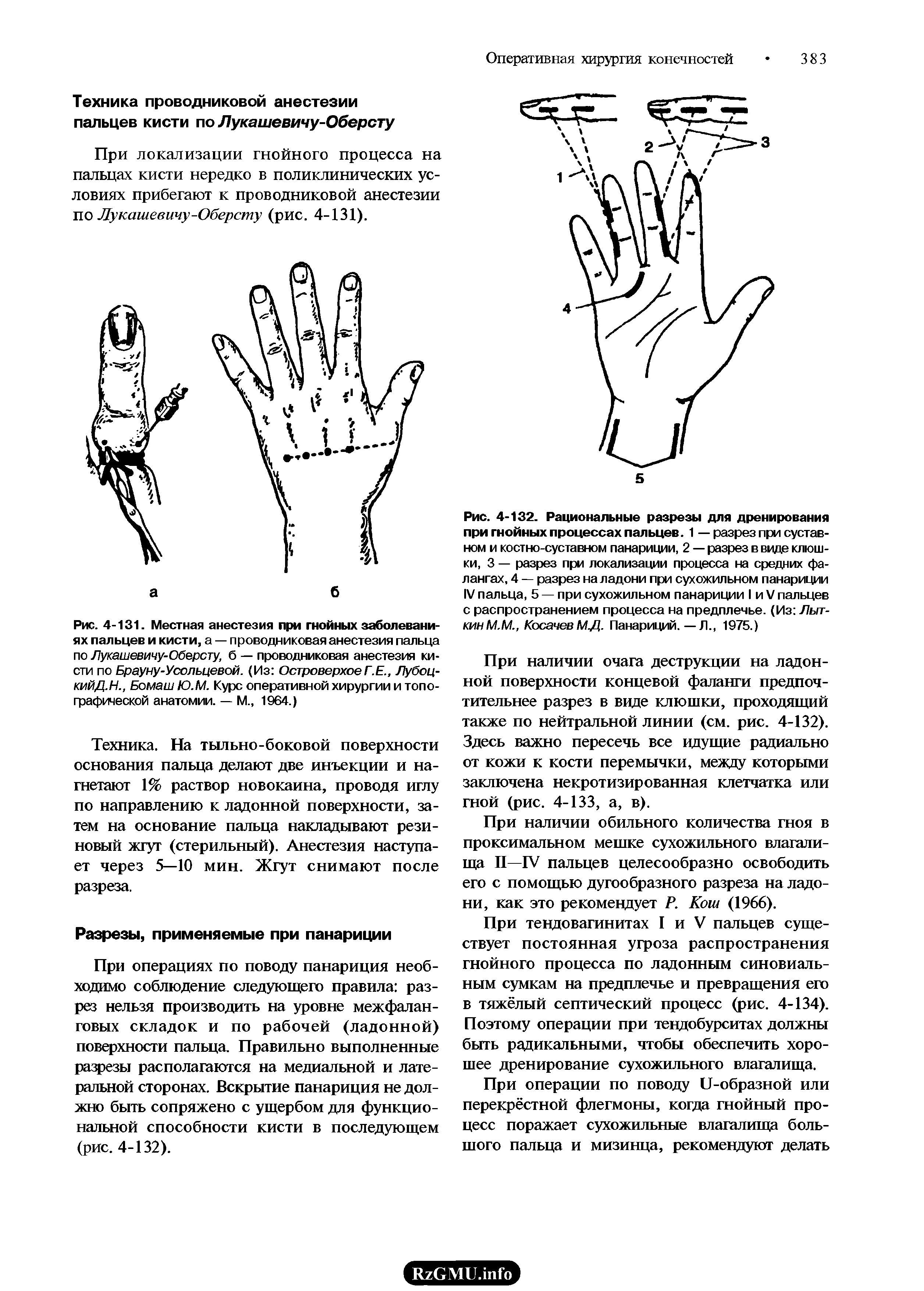 Рис. 4-131. Местная анестезия при гнойных заболеваниях пальцев и кисти, а — проводниковая анестезия пальца по Лукашевичу-Оберсту, б — проводниковая анестезия кисти по Брауну-Усольцевой. (Из ОстроверхоеГ.Е., Лубоц-кийД.Н., Бомаш Ю.М. Курс оперативной хирургии и топографической анатомии. — М., 1964.)...