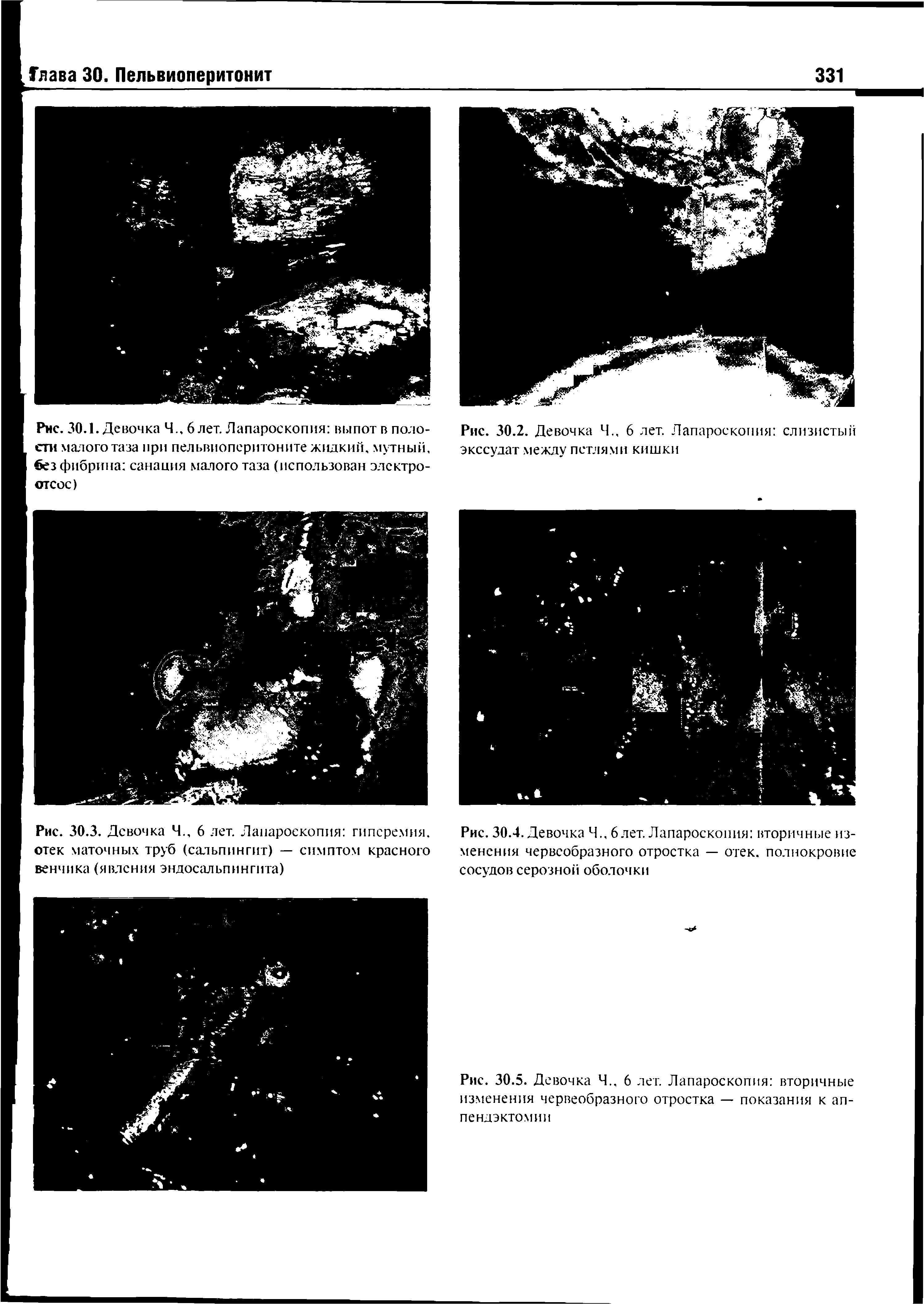 Рис. 30.3. Девочка Ч., 6 лет. Лапароскопия гиперемия, отек маточных труб (сальпингит) — симптом красного венчика (явления эндосальпингита)...