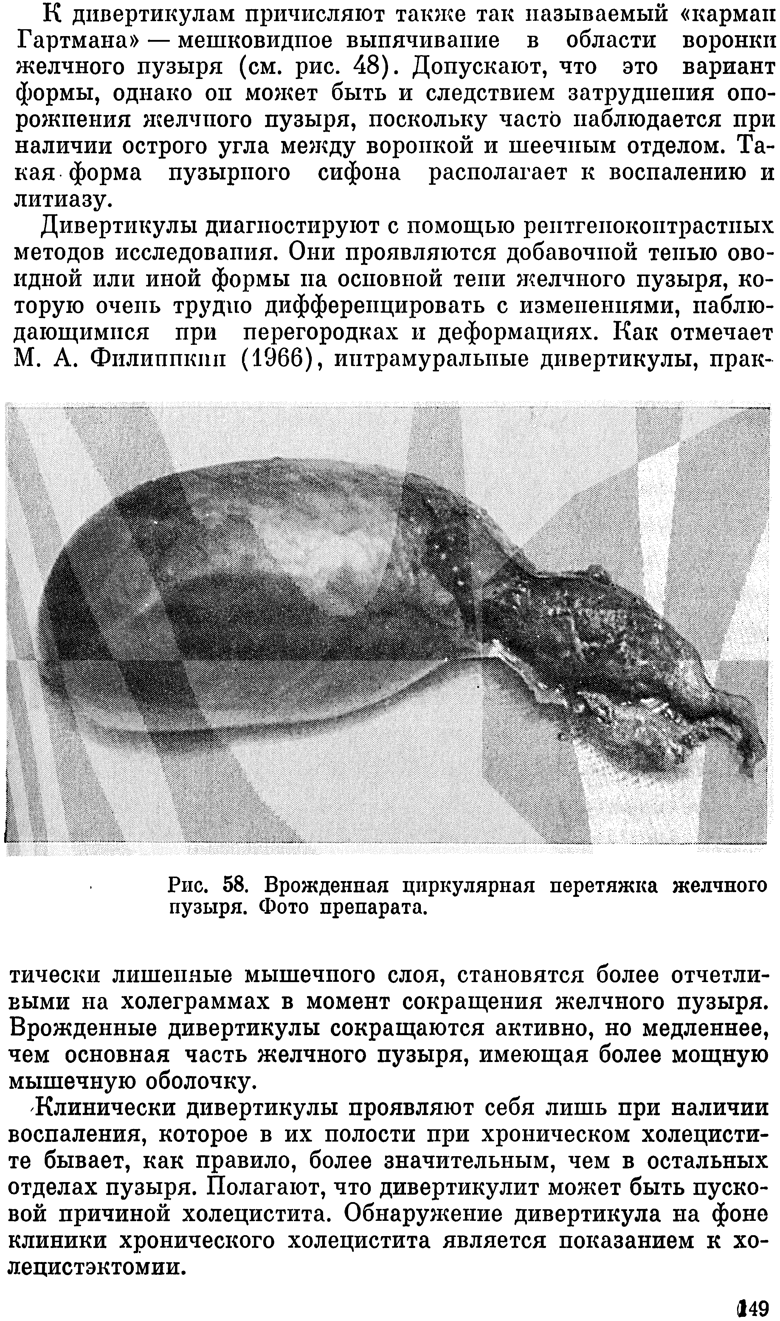 Рис. 58. Врожденная циркулярная перетяжка желчного пузыря. Фото препарата.