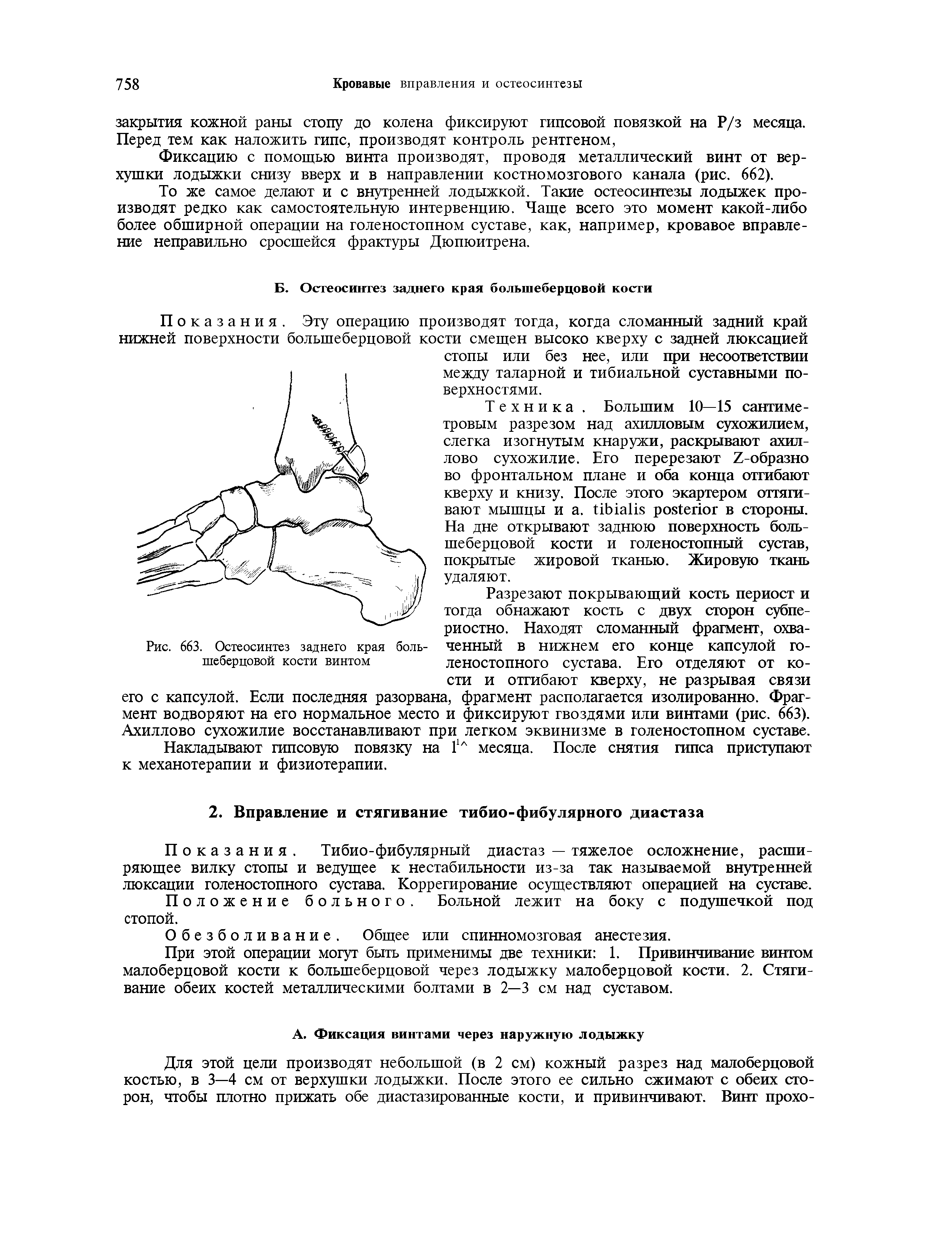 Рис. 663. Остеосинтез заднего края боль- ченный В нижнем его конце капсулой го-шеберцовой кости винтом леностопного сустава. Его отделяют от ко-...