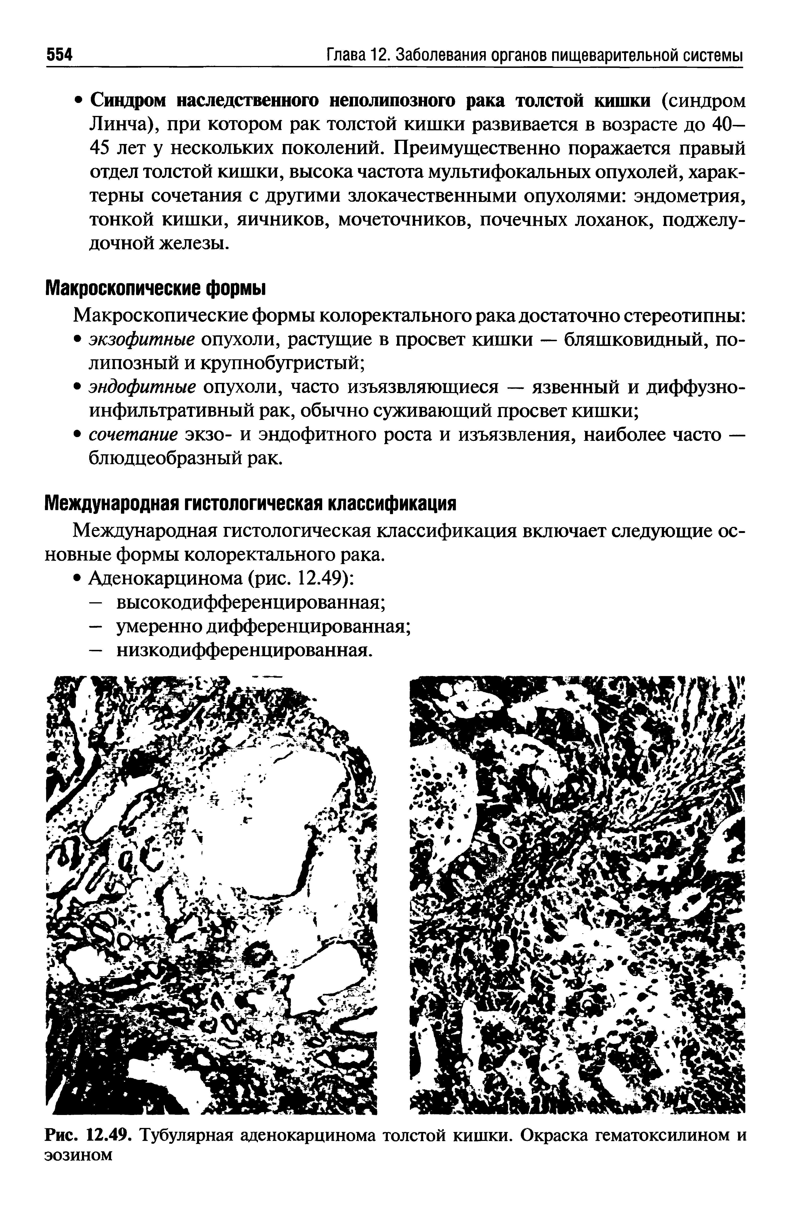 Рис. 12.49. Тубулярная аденокарцинома толстой кишки. Окраска гематоксилином и эозином...