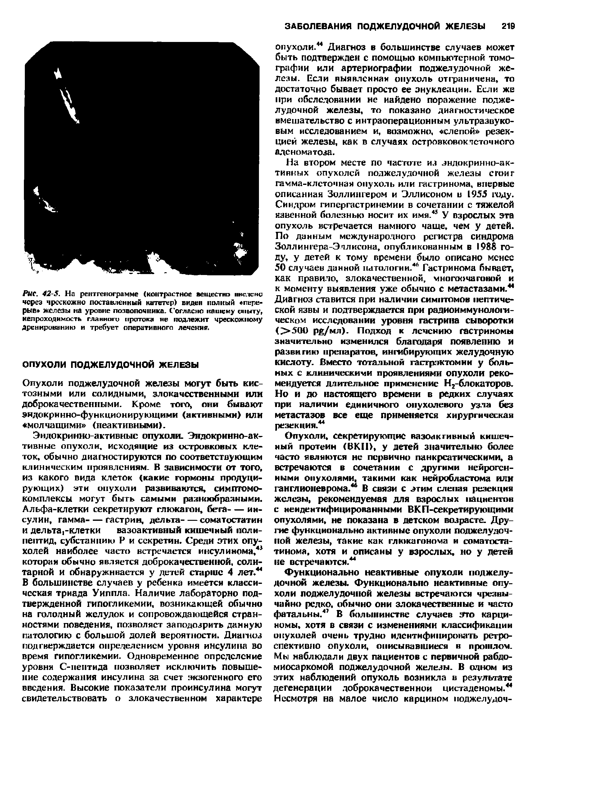 Рис. 42-5. На рентгенограмме (контрастное вещес-гн ннелсно через чрсскожно поставленный катетер) виден полный перерыв железы на уровне позвоночника. Согласно нашему опыту, непроходимость гланноги протока не подлежит чрескожному Дренированию и требует оперативного лечении.