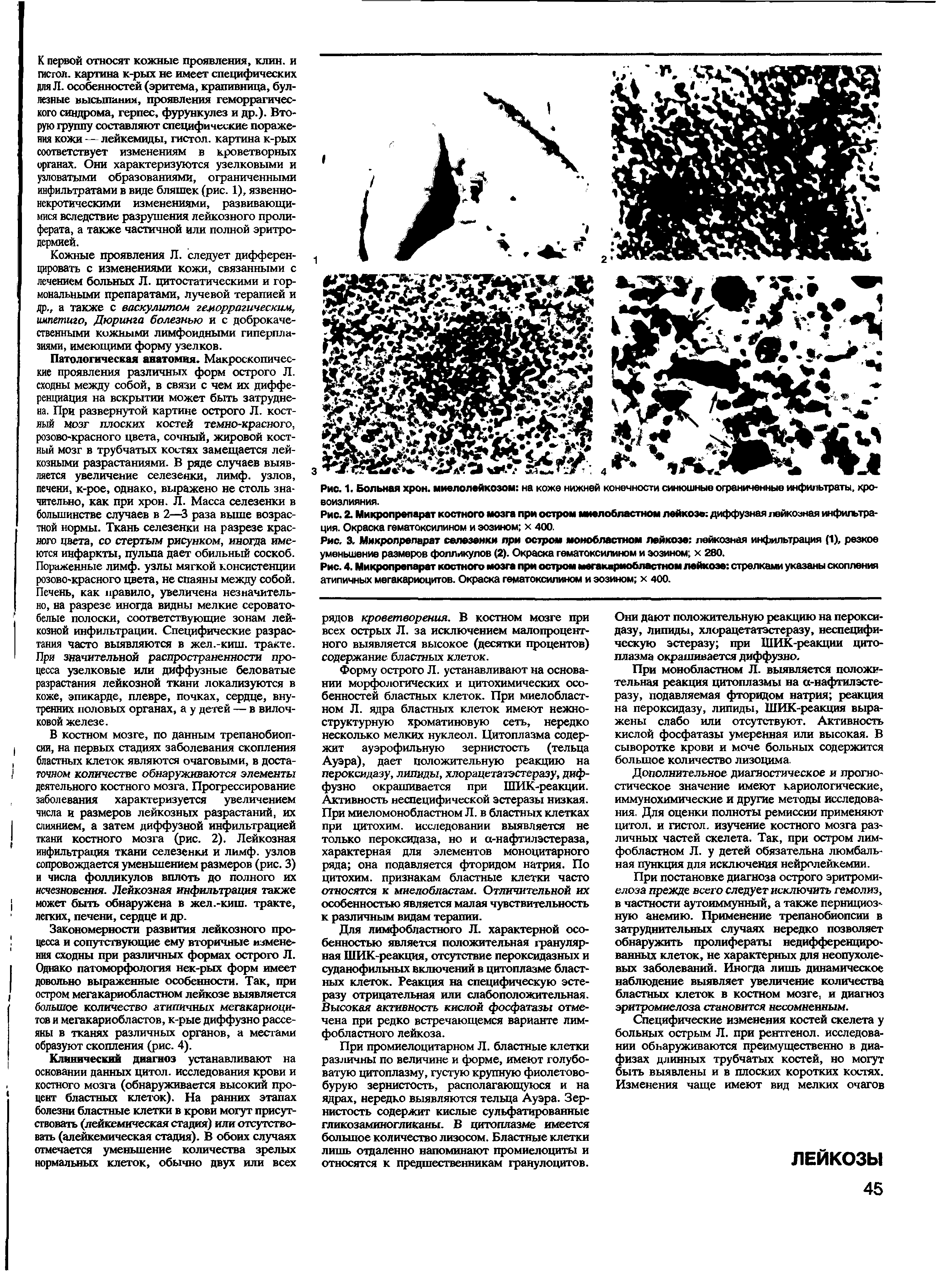 Рис. 2. Микропрепарат костного мозга при остром миелобластном лейкозе диффузная лейкозная инфильтрация. Окраска гематоксилином и эозином х 400.