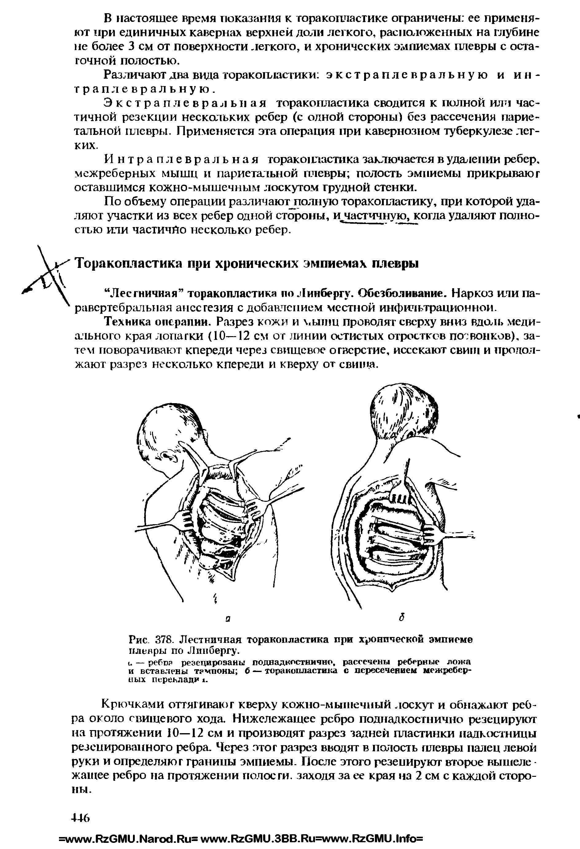 Рис. 378. Лестничная торакопластика при хронической эмпиеме плевры по Линбергу.
