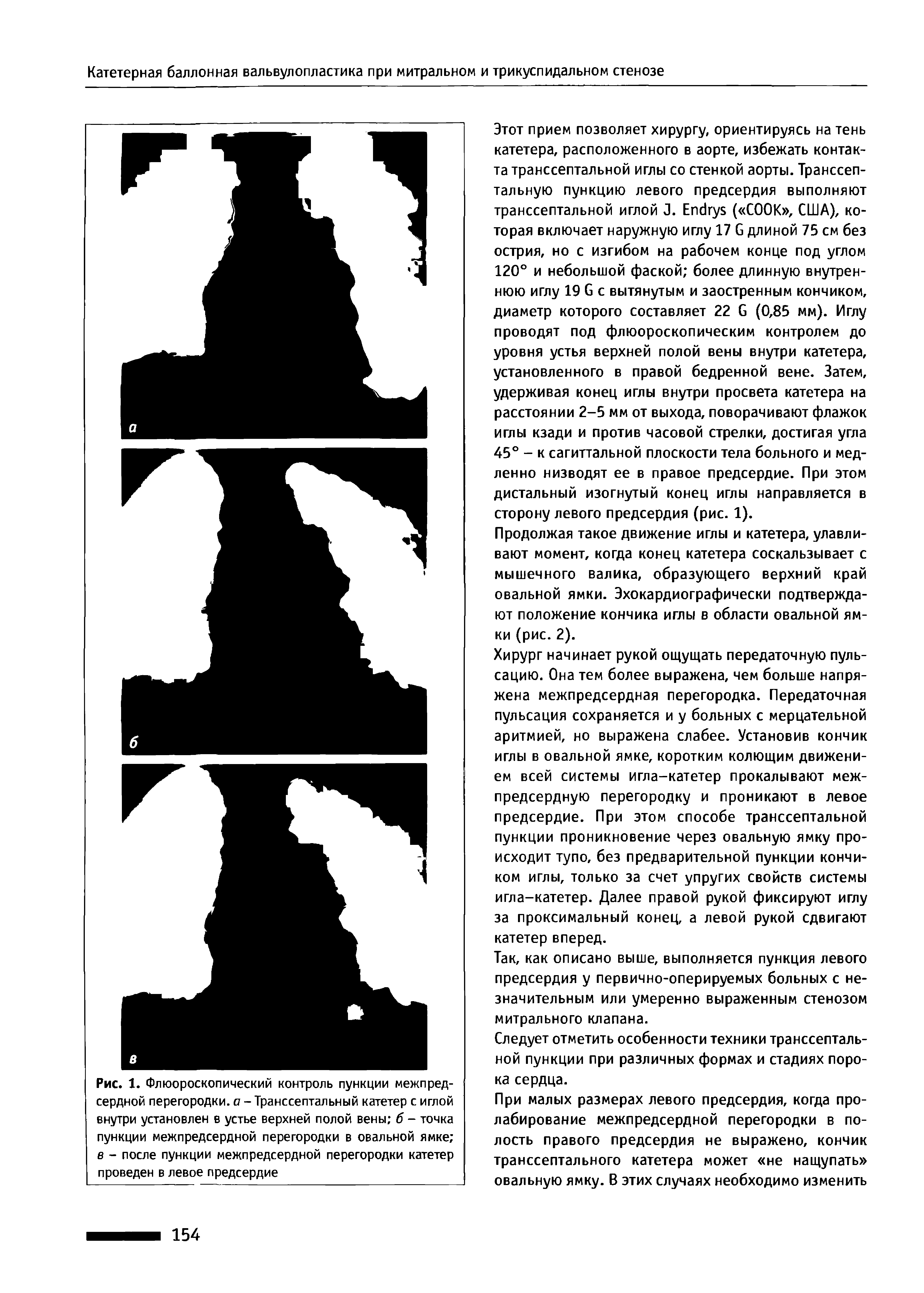 Рис. 1. Флюороскопический контроль пункции межпредсердной перегородки, а - Транссептальный катетер с иглой внутри установлен в устье верхней полой вены б - точка пункции межпредсердной перегородки в овальной ямке в - после пункции межпредсердной перегородки катетер проведен в левое предсердие...