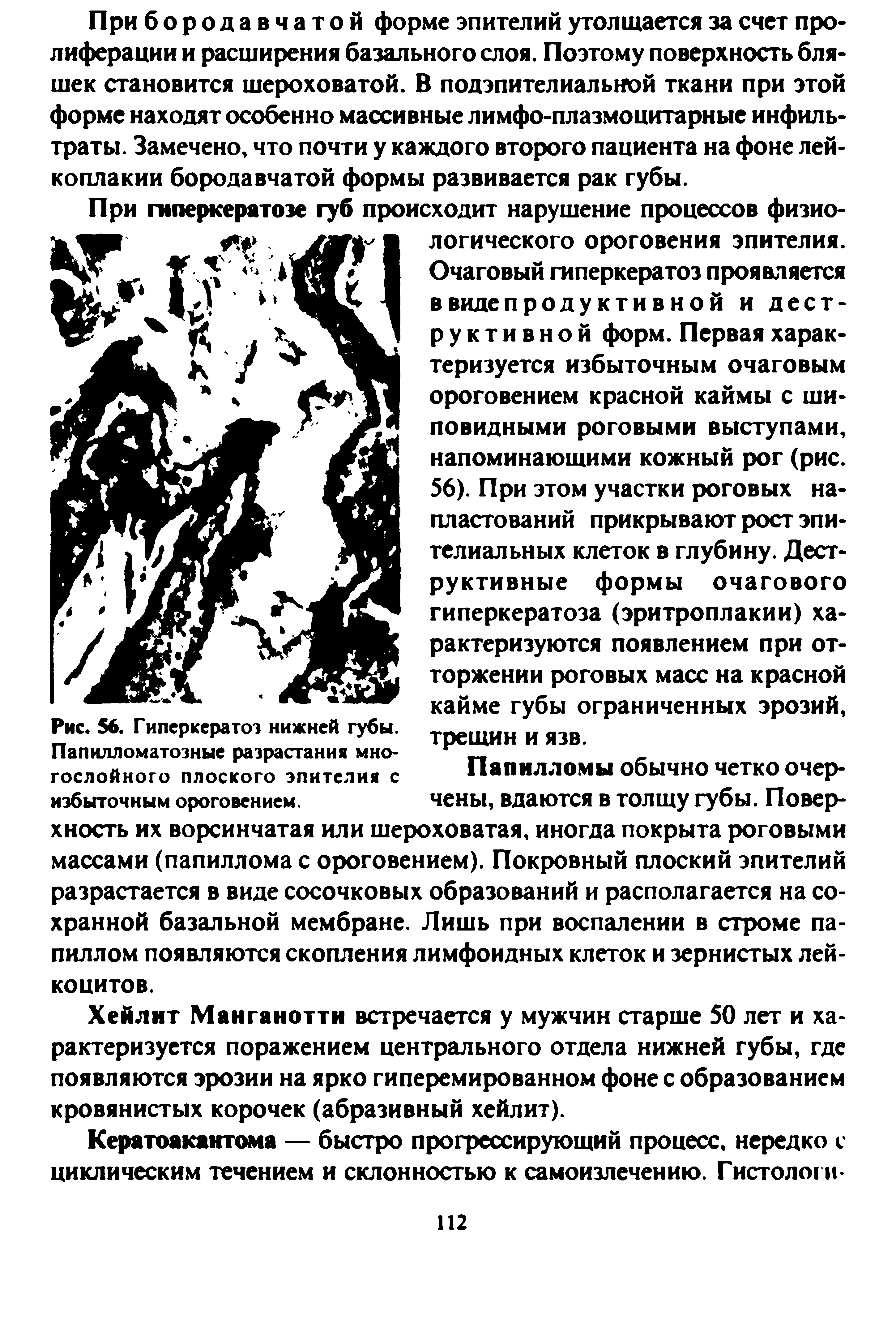 Рис. 56. Гиперкератоз нижней губы. Папилломатозные разрастания многослойного плоского эпителия с избыточным ороговением.