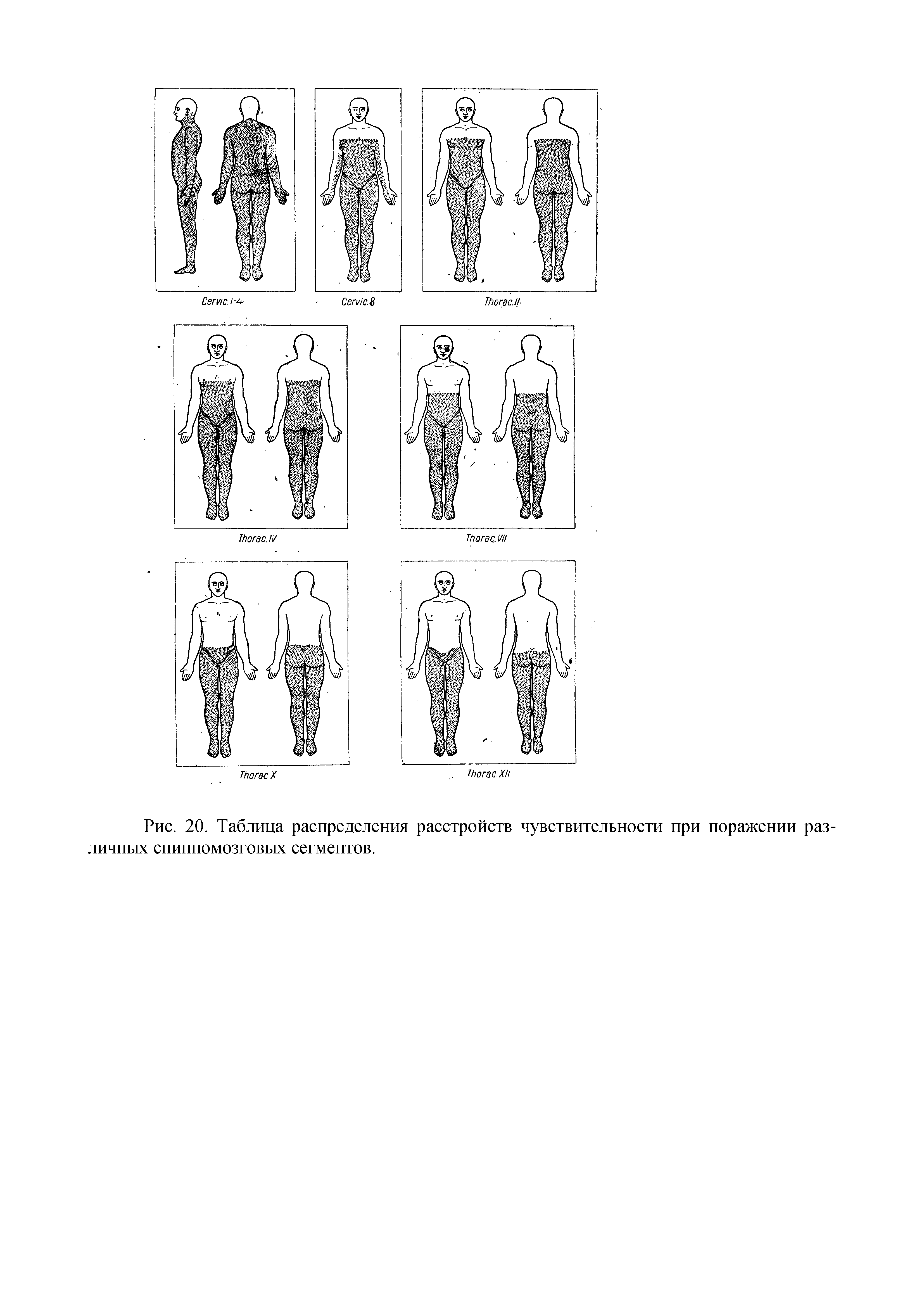 Рис. 20. Таблица распределения расстройств чувствительности при поражении различных спинномозговых сегментов.