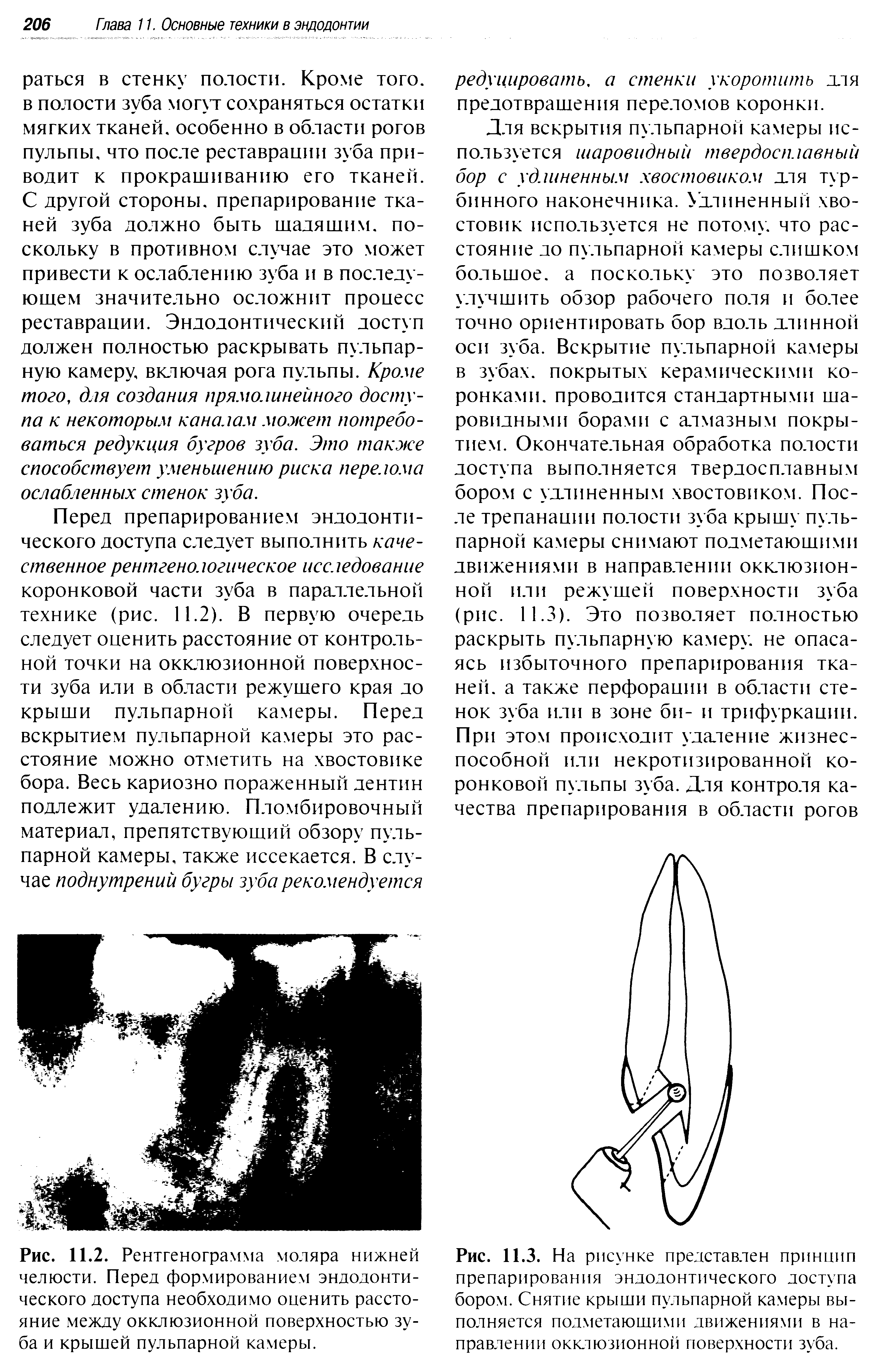 Рис. 11.2. Рентгенограмма моляра нижней челюсти. Перед формированием эндодонтического доступа необходимо оценить расстояние между окклюзионной поверхностью зуба и крышей пульпарной камеры.