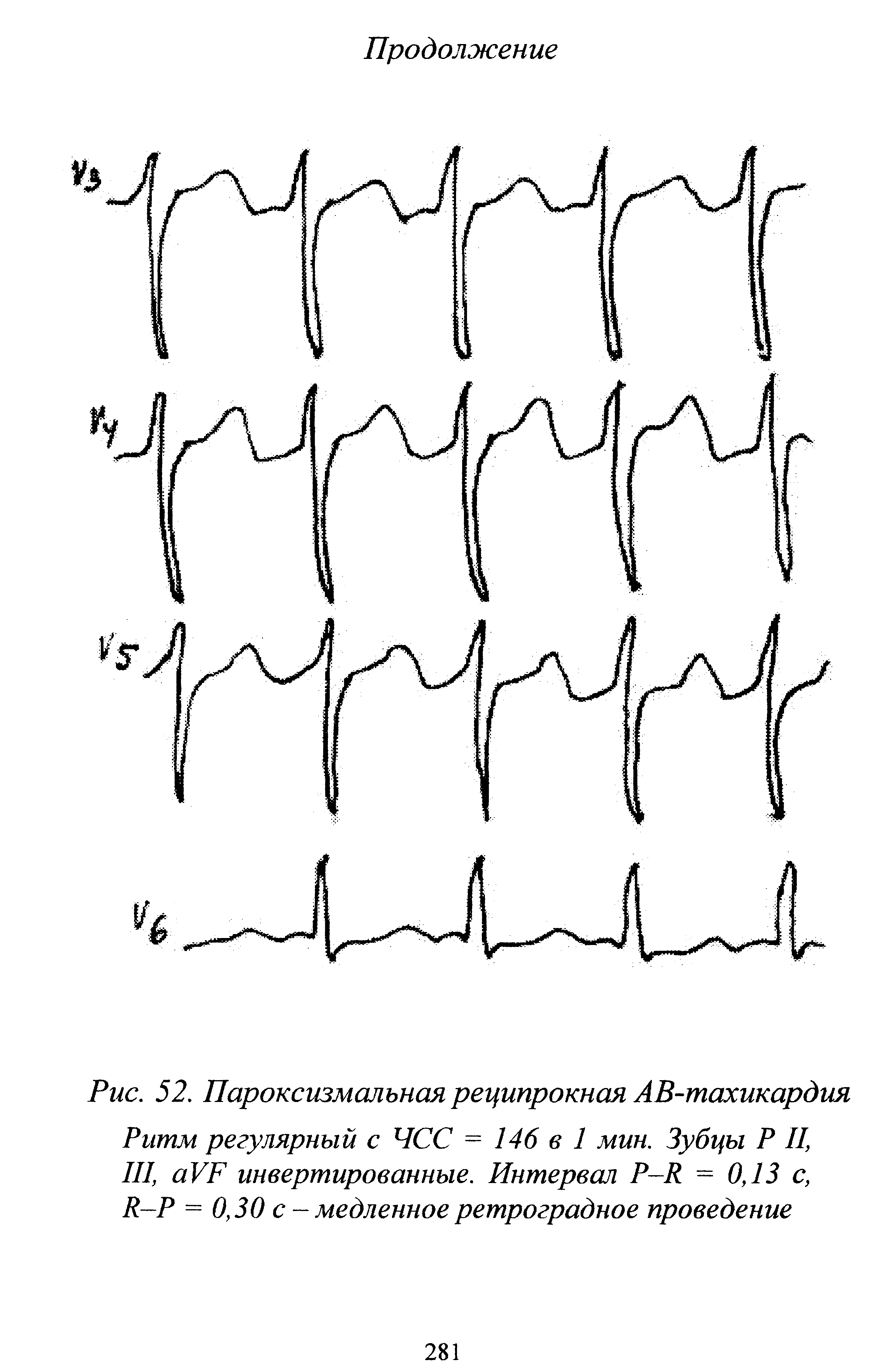 Рис. 52. Пароксизмальная реципрокная АВ-тахикардия Ритм регулярный с ЧСС = 146 в 1 мин. Зубцы Р II, III, аУР инвертированные. Интервал Р-Я = 0,13 с, Л-Р = 0,30 с - медленное ретроградное проведение...