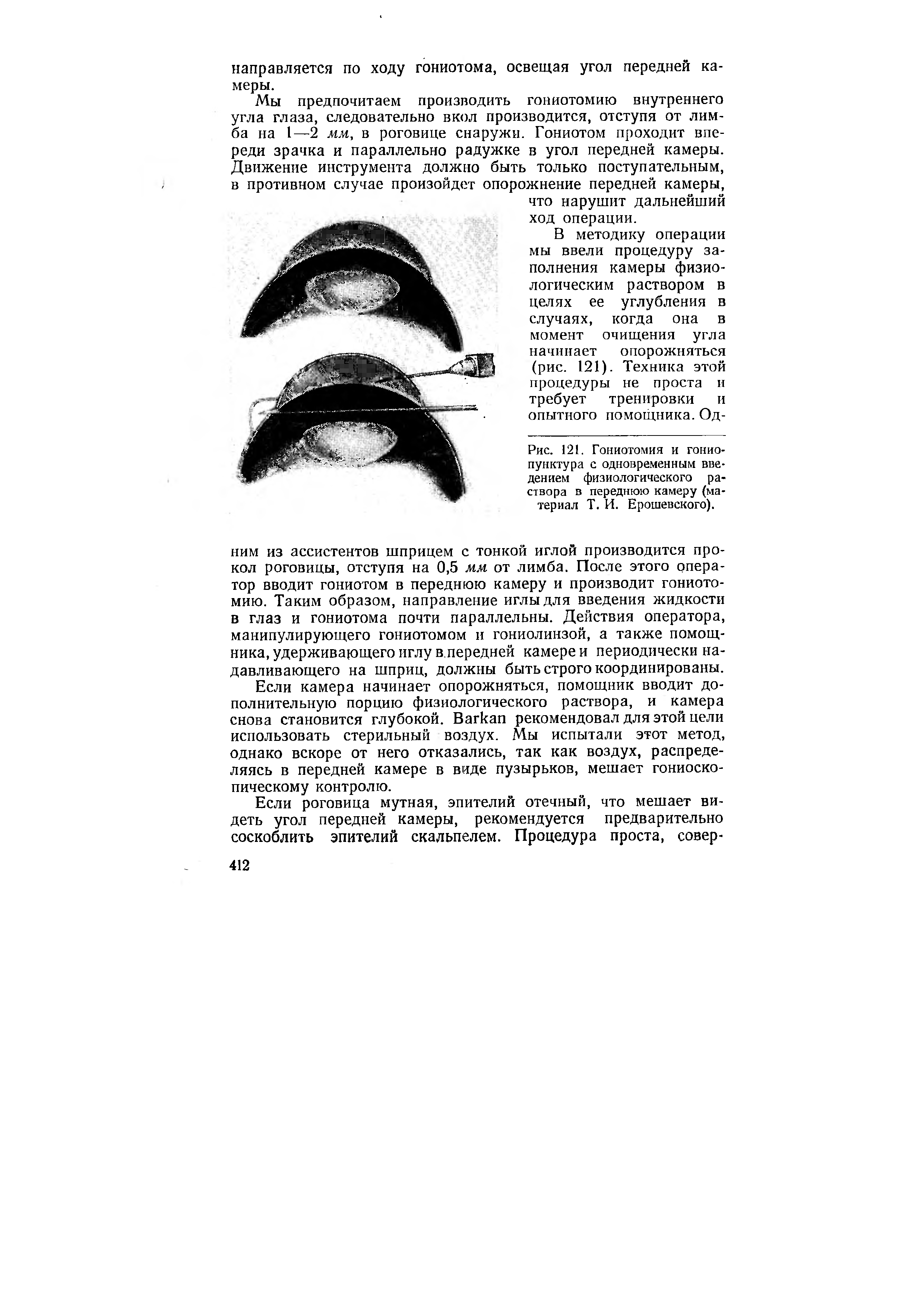 Рис. 121. Гониотомия и гонио-пунктура с одновременным введением физиологического раствора в переднюю камеру (материал Т. И. Брошевского).