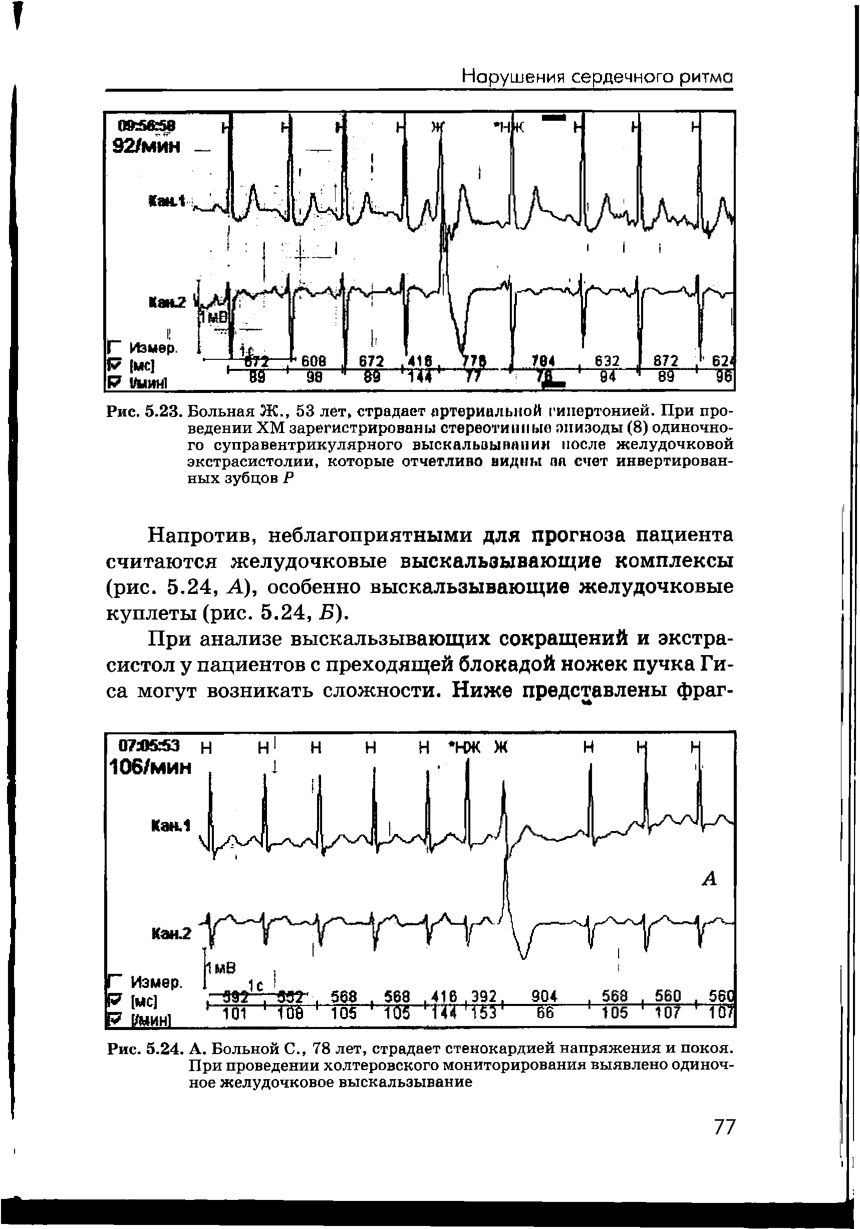 Рис. 5.24. А. Больной С., 78 лет, страдает стенокардией напряжения и покоя. При проведении холтеровского мониторирования выявлено одиночное желудочковое выскальзывание...