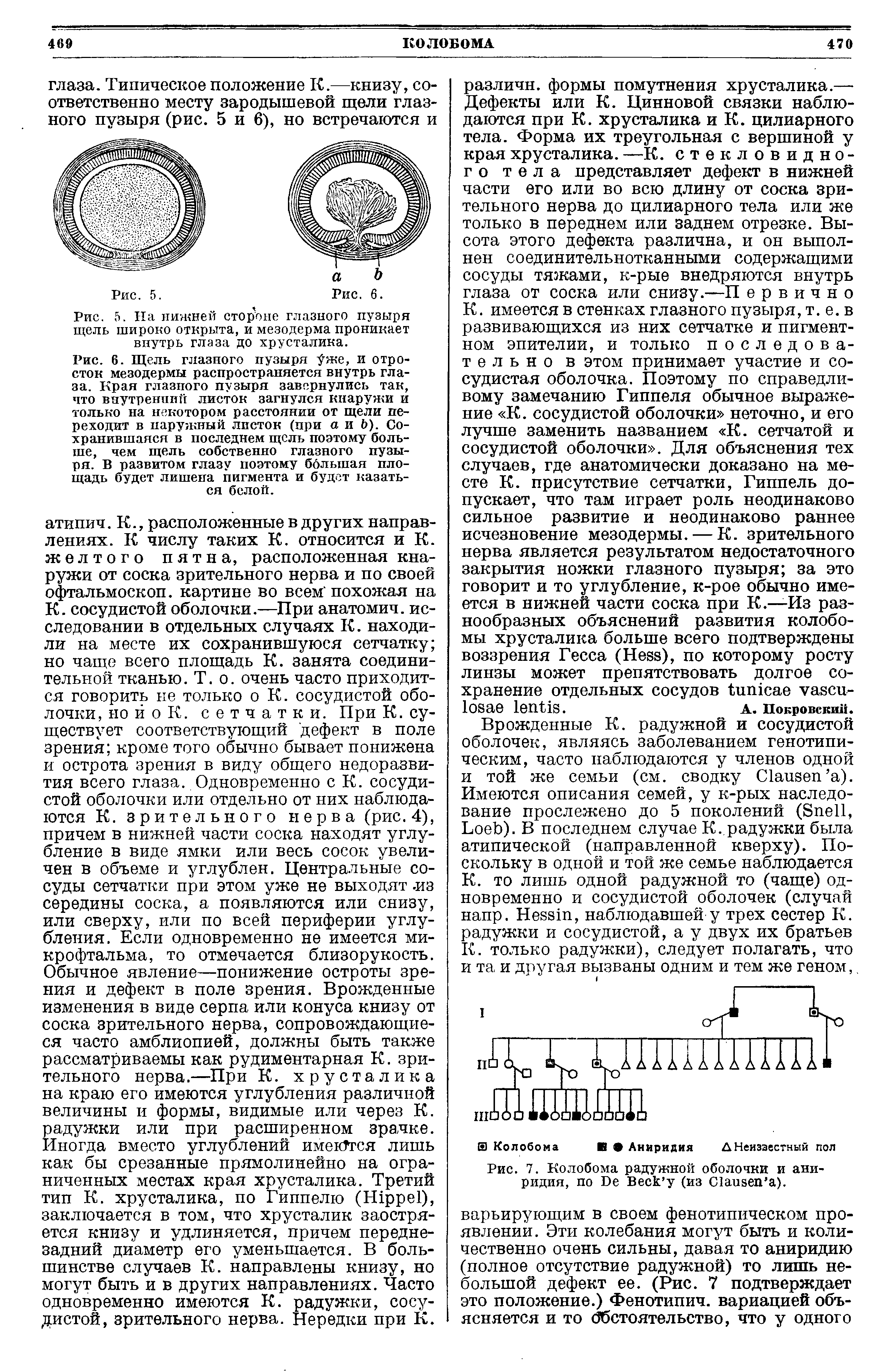 Рис. 7. Колобома радужной оболочки и аниридия, по Бе Веск у (из Шаизеп а).