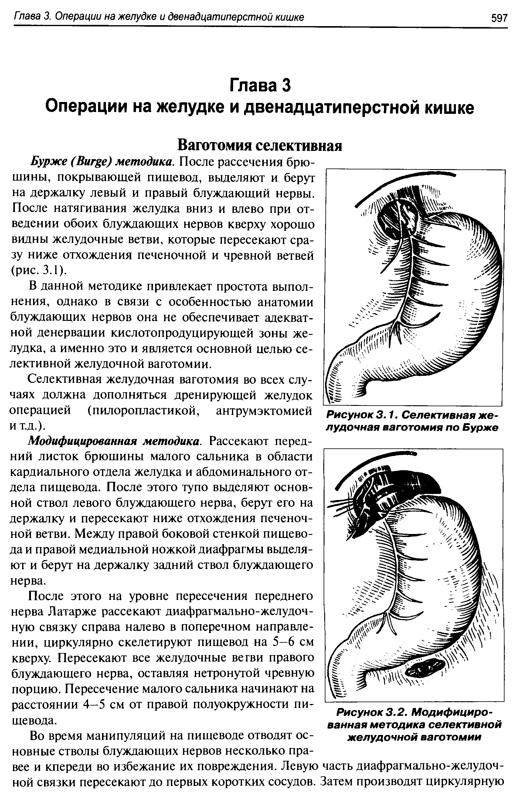 Рисунок 3.2. Модифицированная методика селективной желудочной ваготомии...