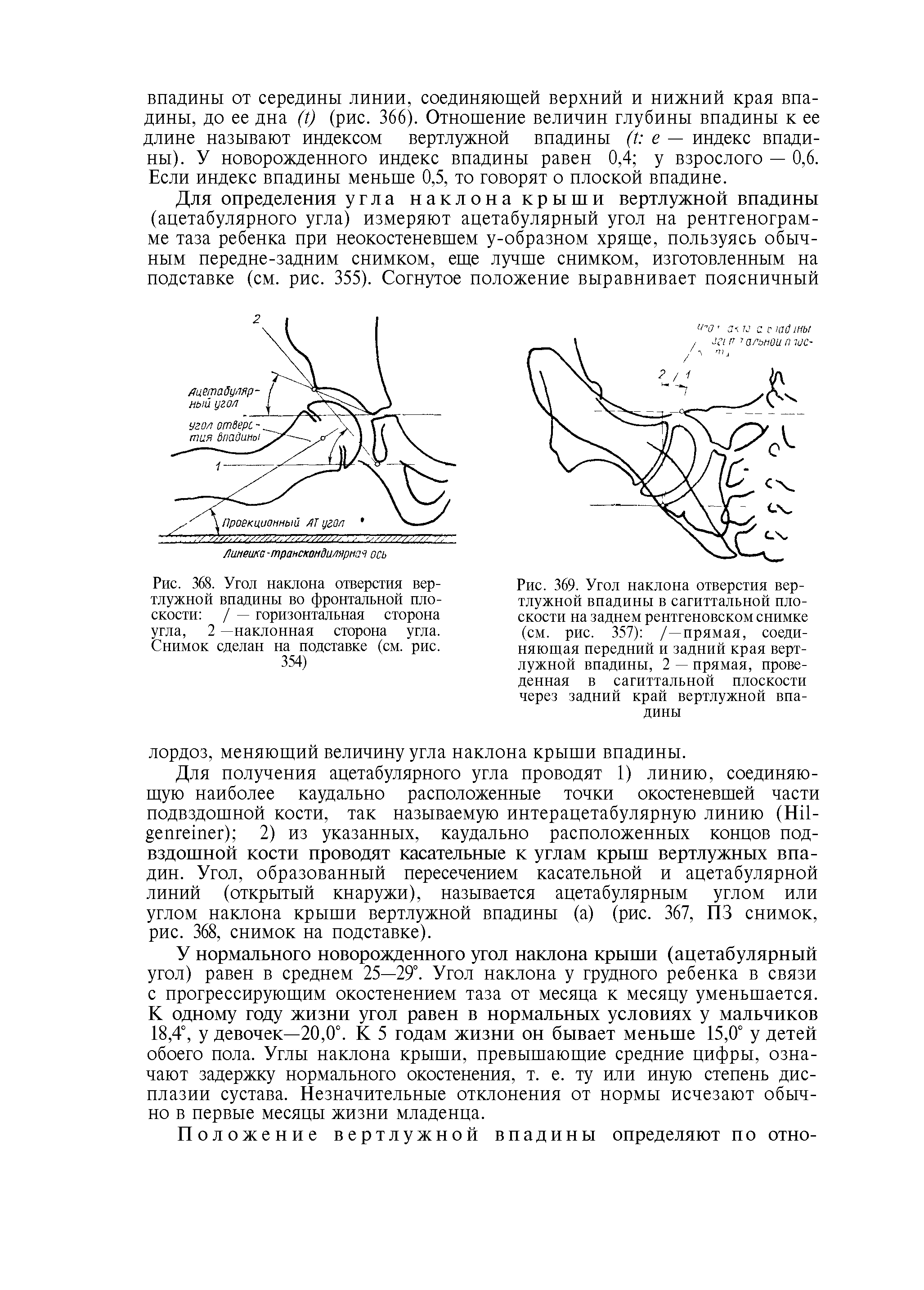 Рис. 369. Угол наклона отверстия вертлужной впадины в сагиттальной плоскости на заднем рентгеновском снимке (см. рис. 357) /—прямая, соединяющая передний и задний края вертлужной впадины, 2 — прямая, проведенная в сагиттальной плоскости через задний край вертлужной впадины...