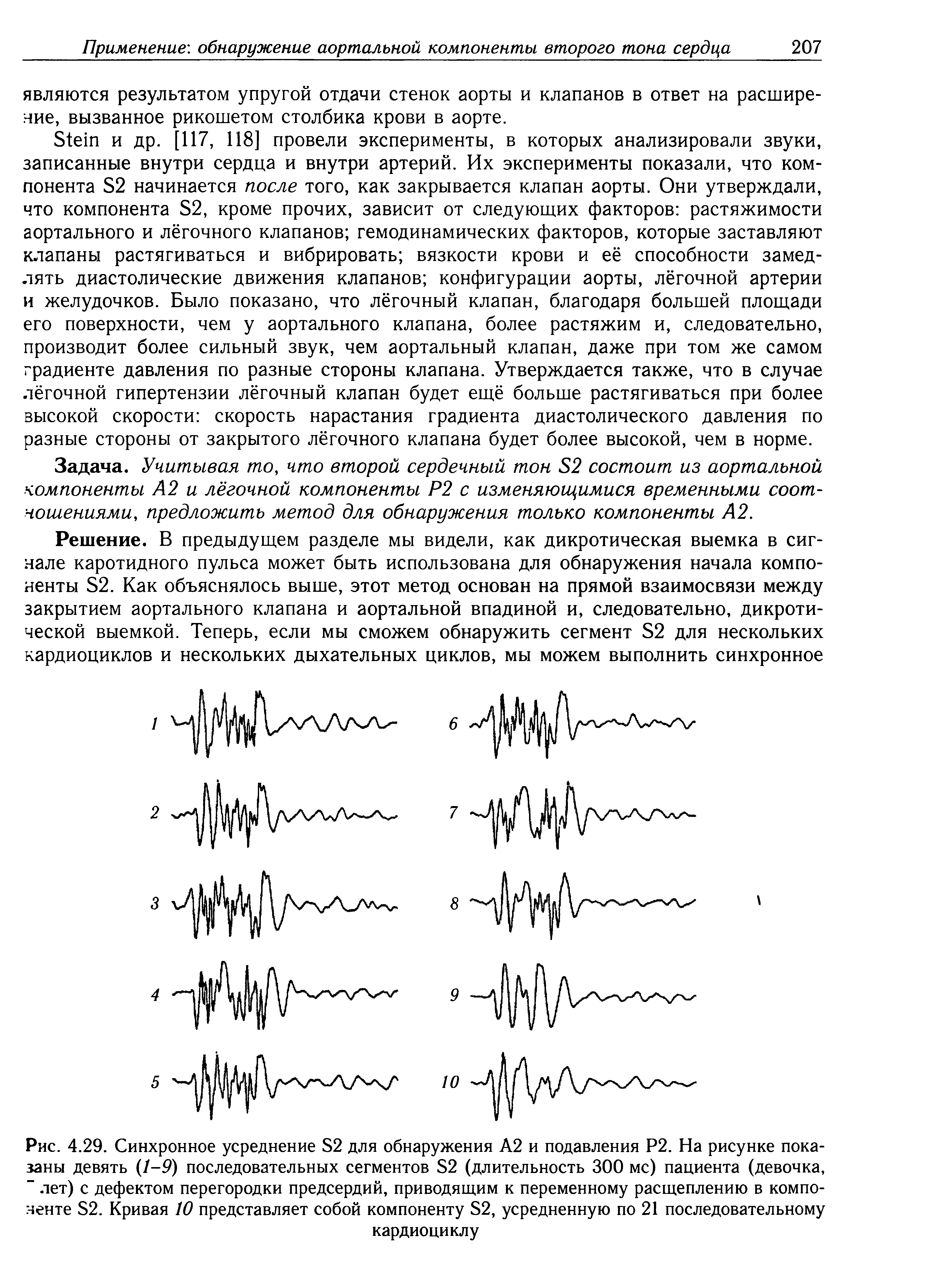 Рис. 4.29. Синхронное усреднение Б2 для обнаружения А2 и подавления Р2. На рисунке показаны девять (1-9) последовательных сегментов Б2 (длительность 300 мс) пациента (девочка, " лет) с дефектом перегородки предсердий, приводящим к переменному расщеплению в компоненте Б2. Кривая 10 представляет собой компоненту Б2, усредненную по 21 последовательному кардиоциклу...