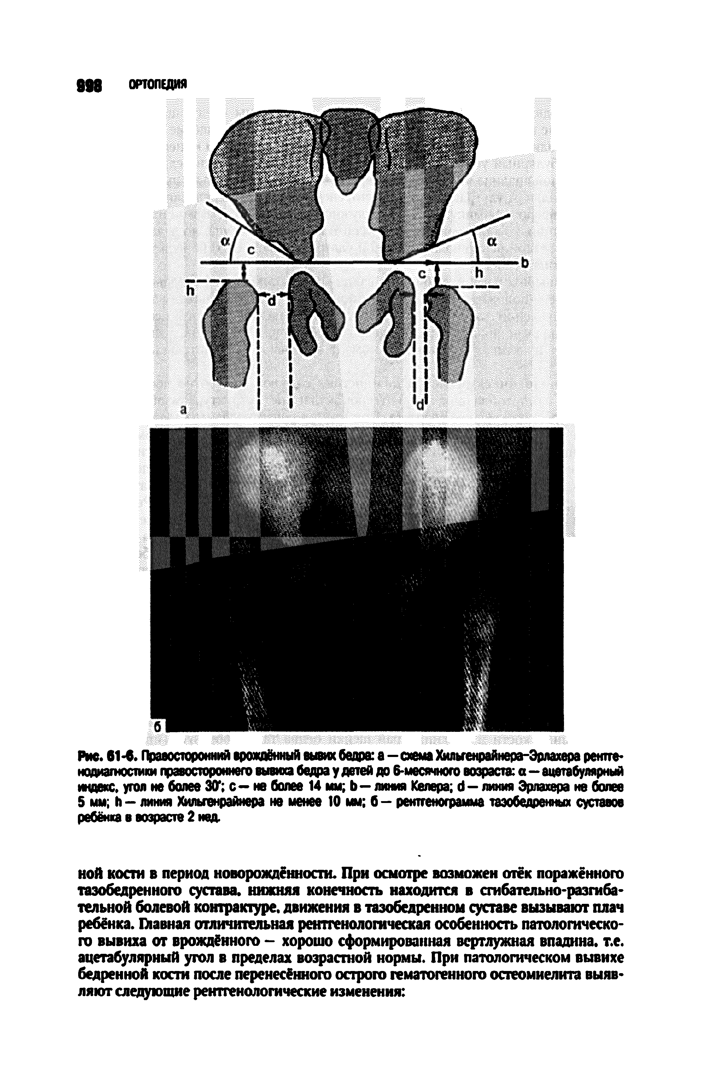 Рис. 61-6. Правосторонний врождённый вывих бедра а—схема Хильгенрайнера-Эрлахера рентгенодиагностики правостороннего вывиха бедра у детей до 6-месячного возраста а—ацетабулярный индекс, угол не более 30 с— не более 14 мм Ь— линия Келера б—линия Эрлахера не более 5 мм й - линия Хильгенрайнера не менее 10 мм б - рентгенограмма тазобедренных суставов ребёнка в возрасте 2 нед.