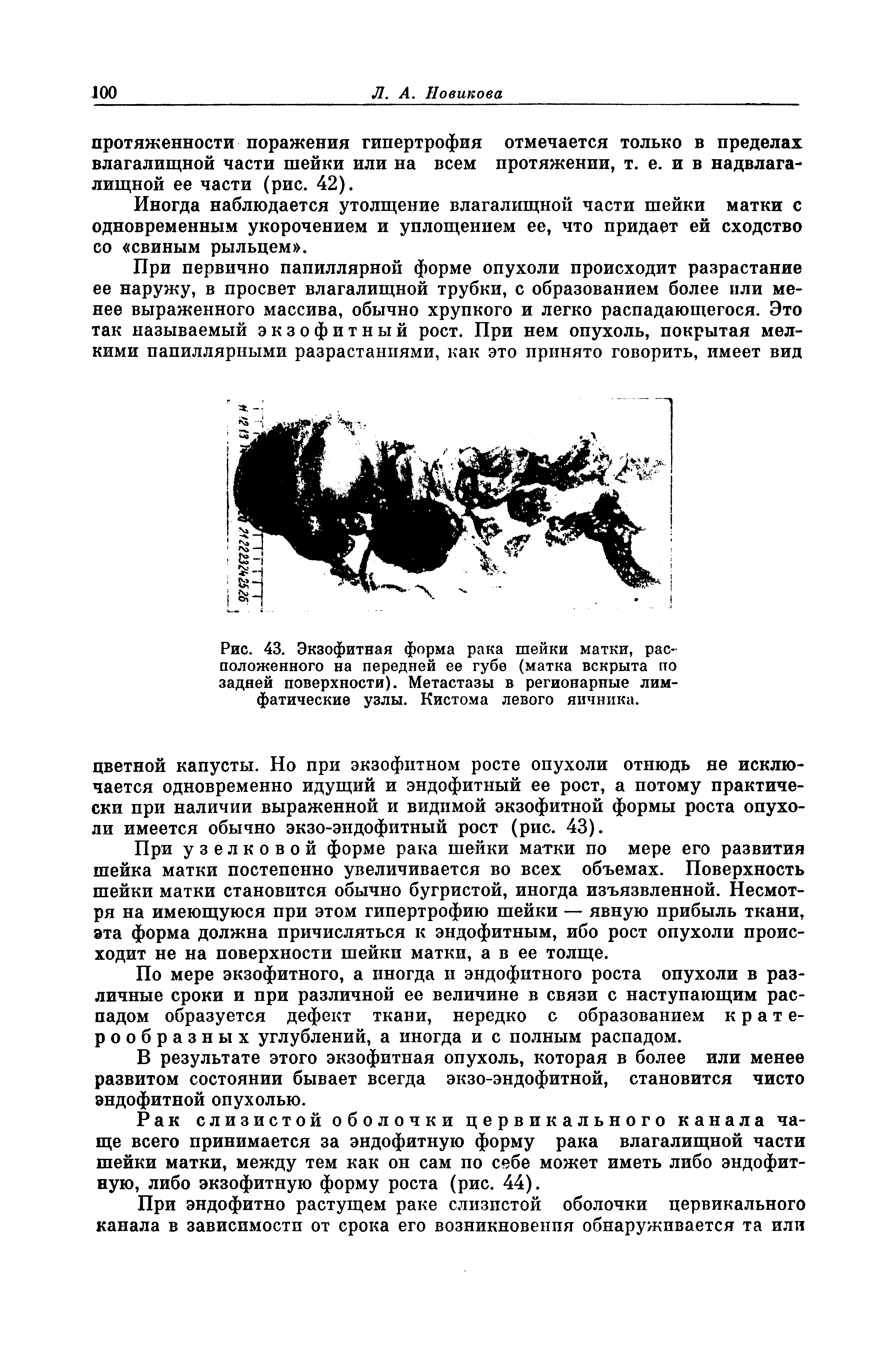 Рис. 43. Экзофитная форма рака шейки матки, расположенного на передней ее губе (матка вскрыта по задней поверхности). Метастазы в регионарные лимфатические узлы. Кистома левого яичника.