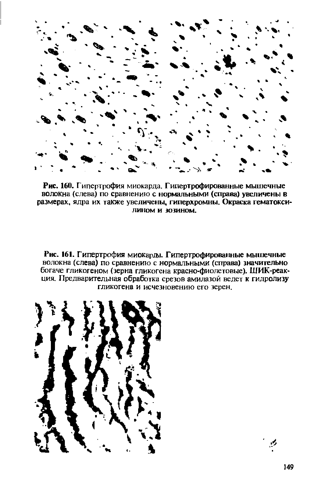 Рис. 161. Гипертрофия миокарда. Гипертрофированные мышечные волокна (слева) по сравнению с нормальными (справа) значительно богаче гликогеном (зерна гликогена красно-фиолетовые). ШИК-реак-ция. Предварительная обработка срезов амилазой ведет к гидролизу гликогена и исчезновению его зерен.