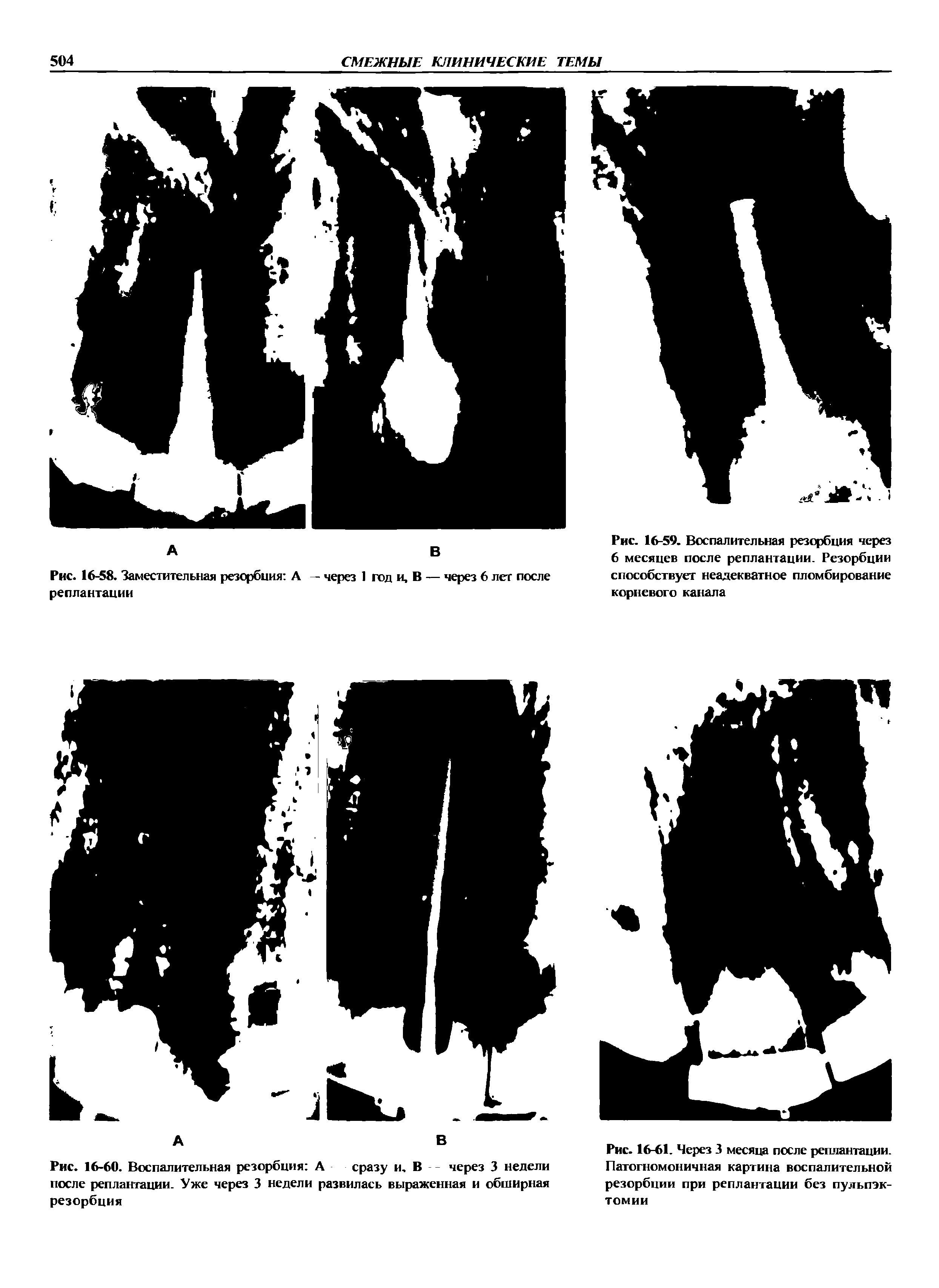 Рис. 16-60. Воспалительная резорбция А сразу и. В через 3 недели после реплантации. Уже через 3 недели развилась выраженная и обширная резорбция...