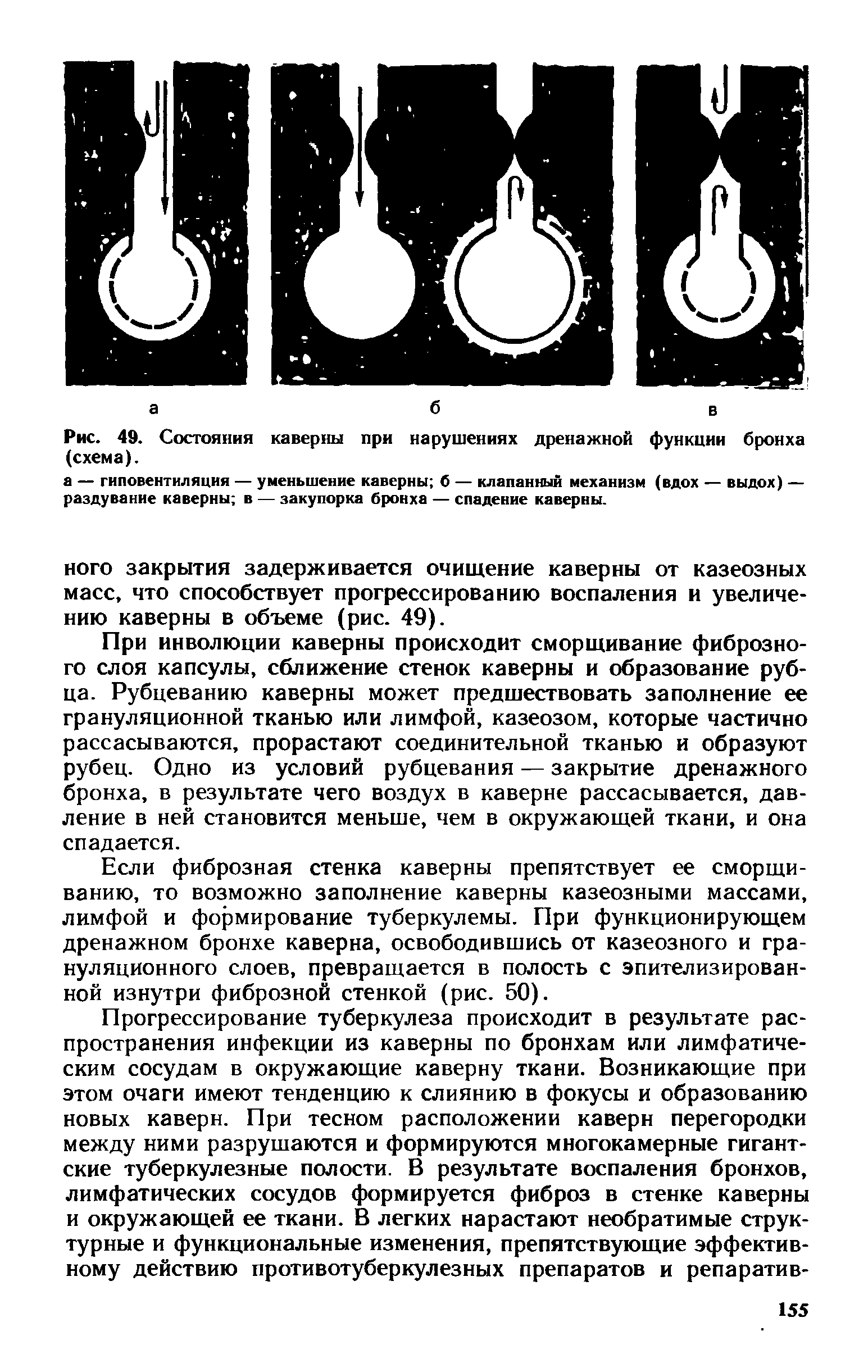 Рис. 49. Состояния каверны при нарушениях дренажной функции бронха (схема).