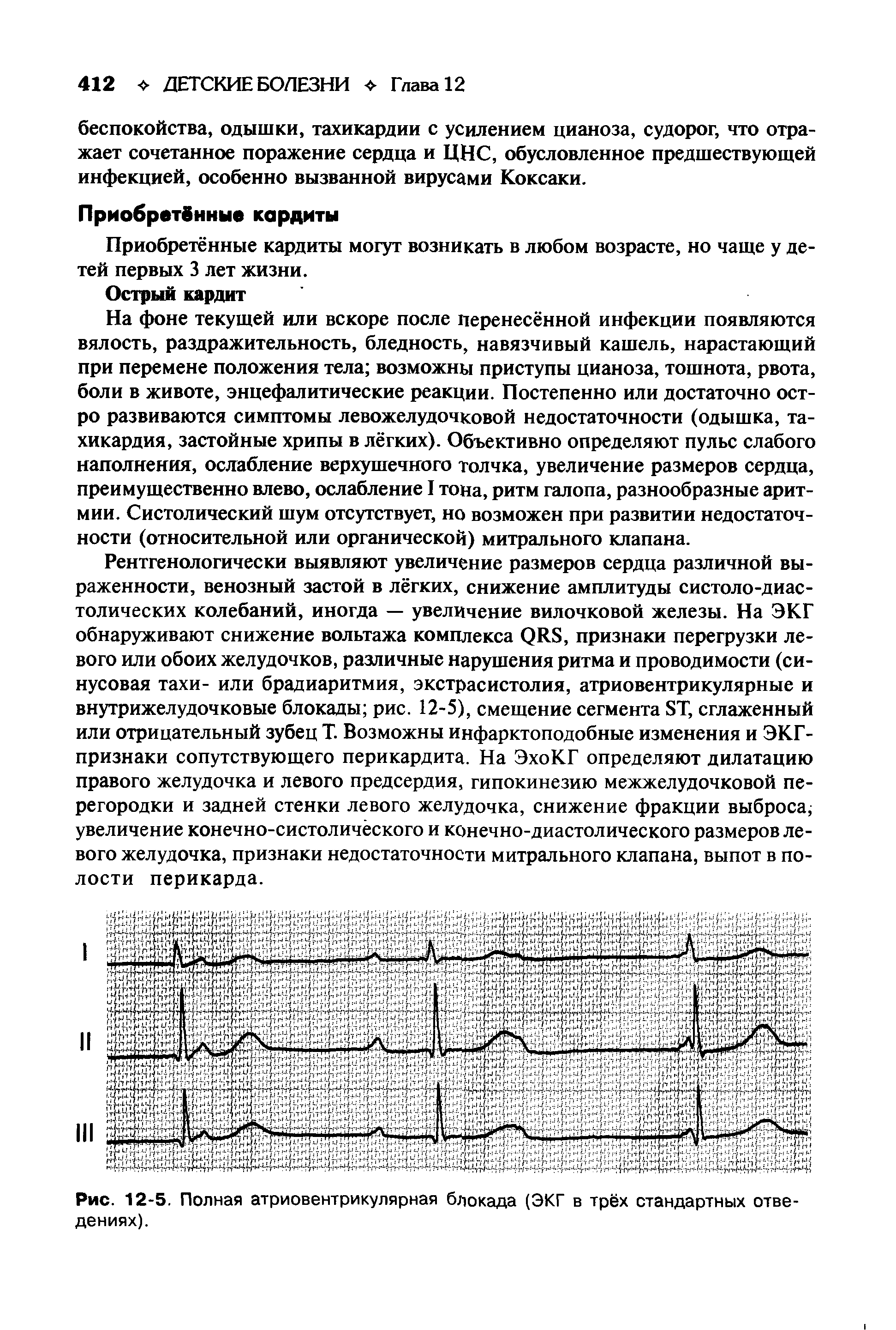 Рис. 12-5. Полная атриовентрикулярная блокада (ЭКГ в трёх стандартных отведениях).