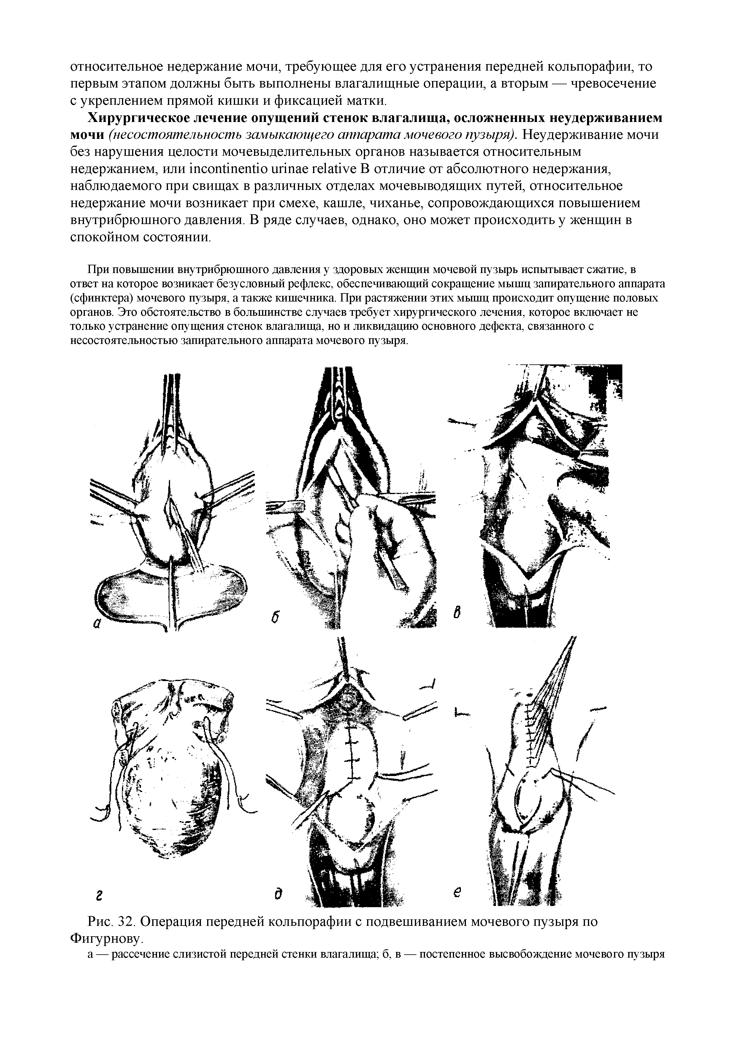 Рис. 32. Операция передней кольпорафии с подвешиванием мочевого пузыря по Фигурнову.