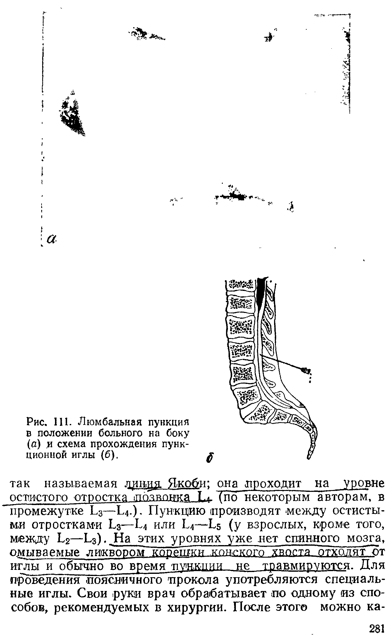 Рис. 111. Люмбальная пункция в положении больного на боку (д) и схема прохождения пункционной иглы (б).