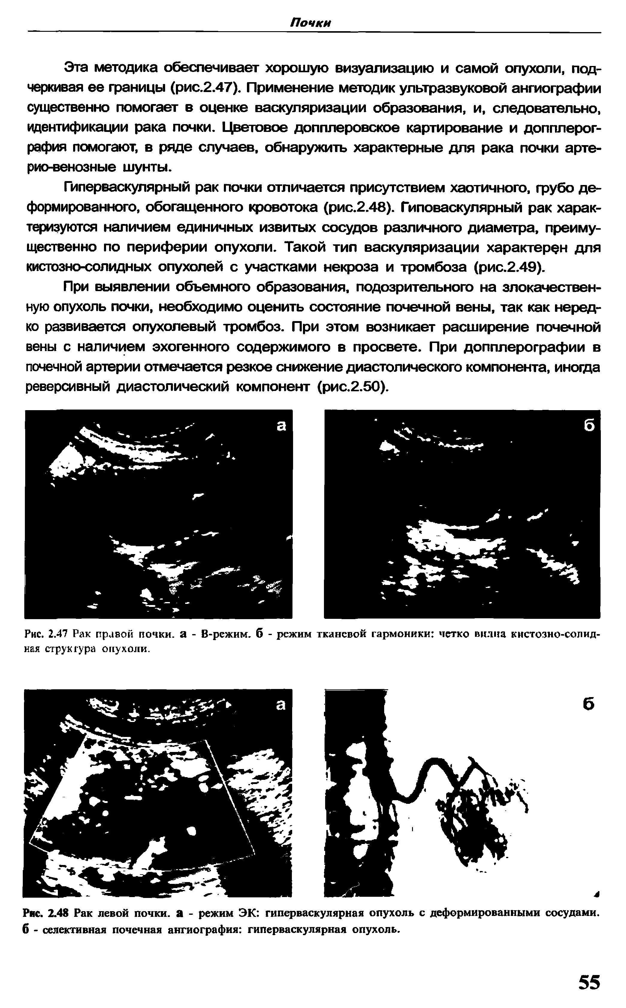 Рис. 2.47 Рак правой почки, а - В-режим. б - режим тканевой гармоники четко видна кистозно-солидная структура опухоли.