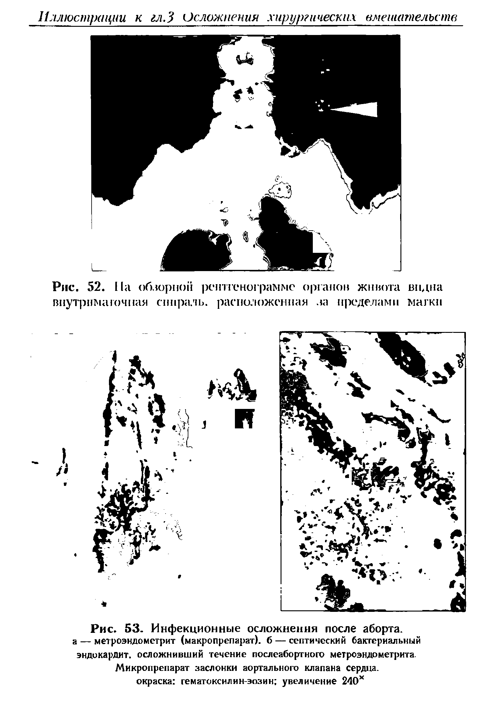 Рис. 53. Инфекционные осложнения после аборта, а — метроэндометрит (макропрепарат), б — септический бактериальный эндокардит, осложнивший течение послеабортного метроэндометрита. Микропрепарат заслонки аортального клапана сердца, окраска гематоксилин-эозин увеличение 240х...