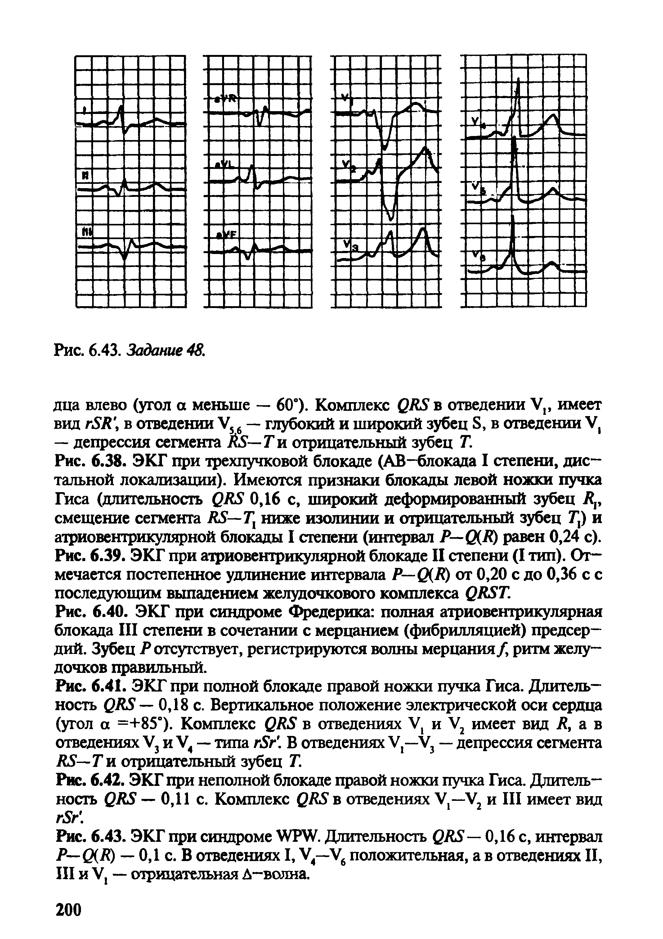 Рис. 6.38. ЭКГ при трехпучковой блокаде (АВ-блокада I степени, дистальной локализации). Имеются признаки блокады левой ножки пучка Гиса (длительность СЯ5 0,16 с, широкий деформированный зубец смещение сегмента Л5—7] ниже изолинии и отрицательный зубец и атриовентрикулярной блокады I степени (интервал Р—0(К) равен 0,24 с).