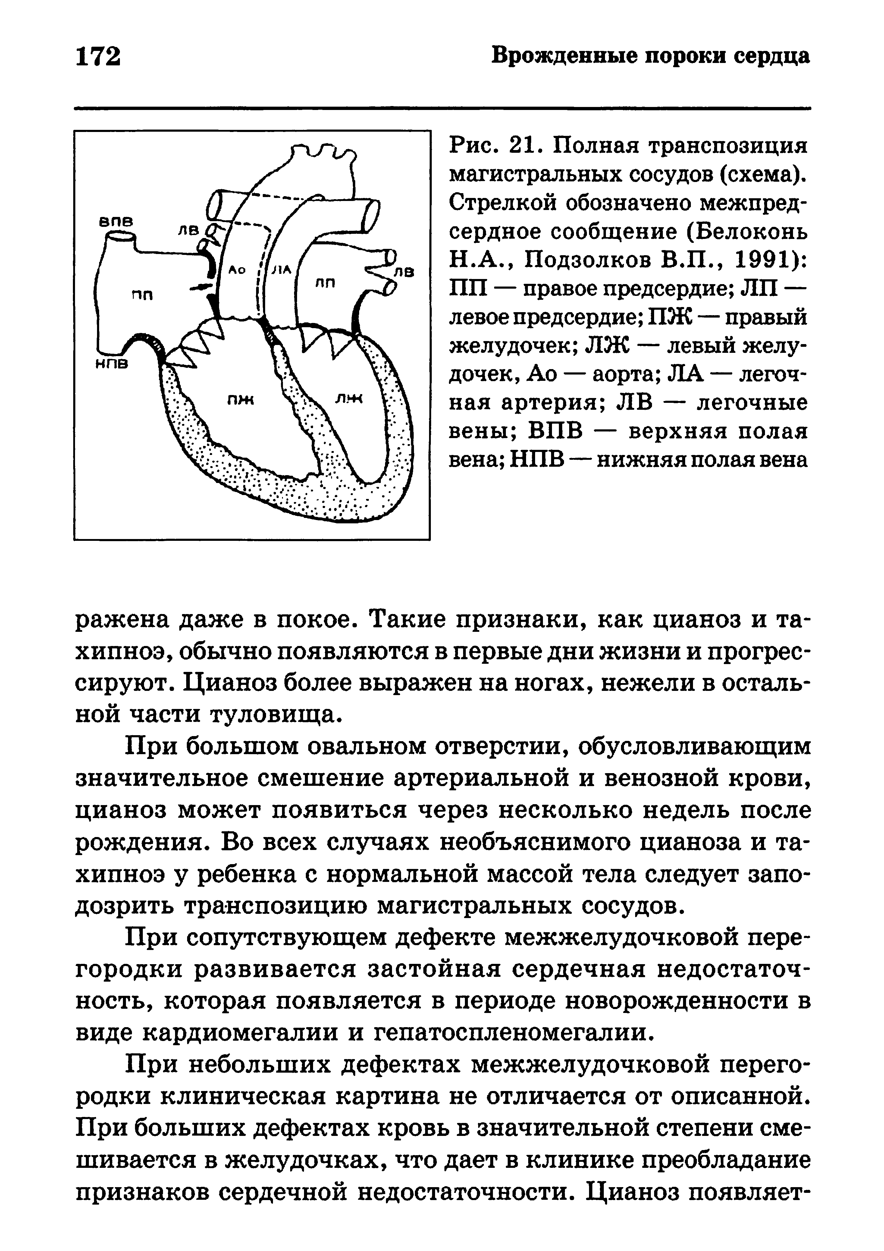 Рис. 21. Полная транспозиция магистральных сосудов (схема). Стрелкой обозначено межпредсердное сообщение (Белоконь Н.А., Подзолков В.П., 1991) ПП — правое предсердие ЛП — левое предсердие ПЖ — правый желудочек ЛЖ — левый желудочек, Ао — аорта ЛА — легочная артерия ЛВ — легочные вены ВПВ — верхняя полая вена НПВ — нижняя полая вена...