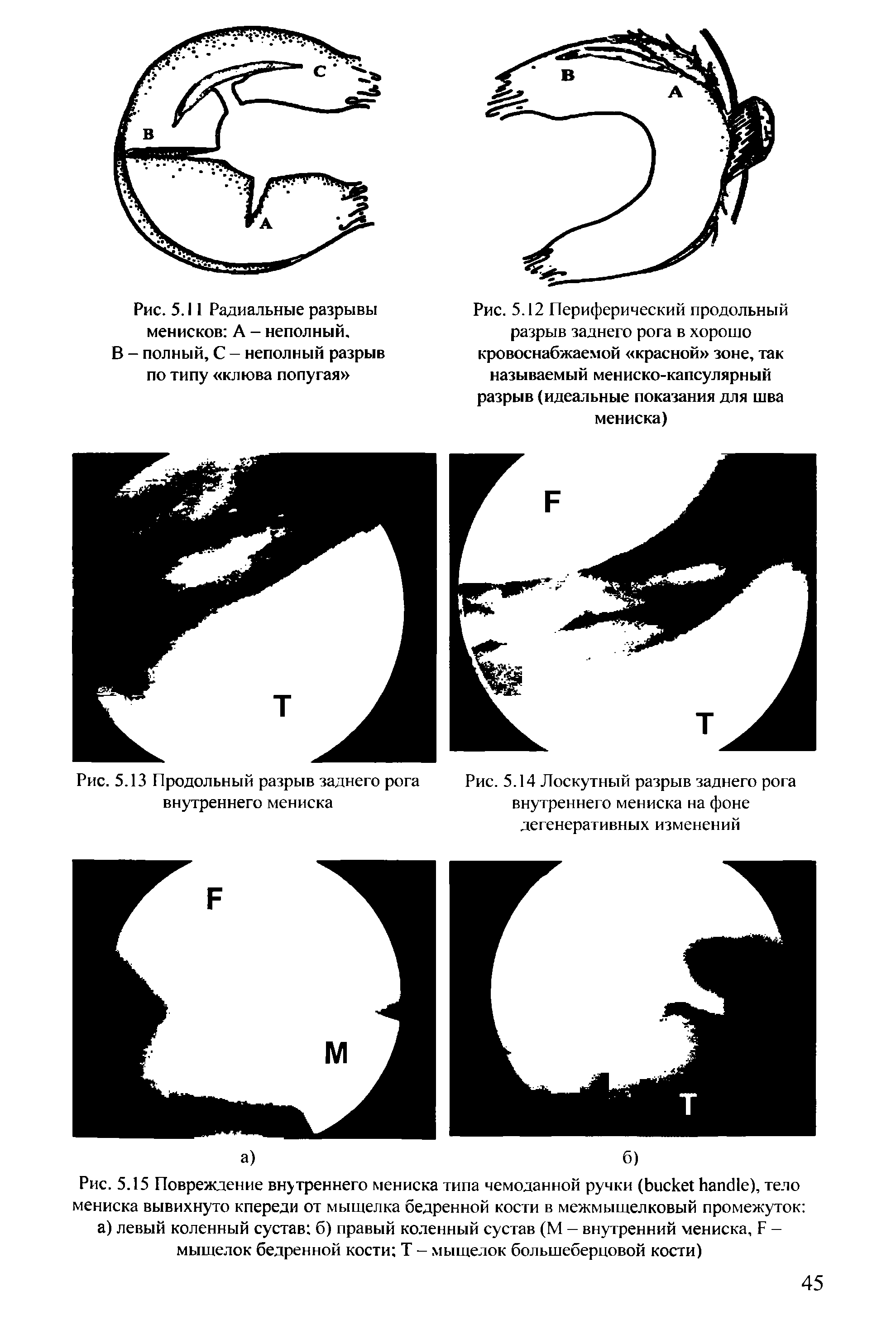 Рис. 5.15 Повреждение внутреннего мениска типа чемоданной ручки ( ), тело мениска вывихнуто кпереди от мыщелка бедренной кости в межмыщелковый промежуток а) левый коленный сустав б) правый коленный сустав (М — внутренний мениска, F -мыщелок бедренной кости Т - мыщелок большеберцовой кости)...
