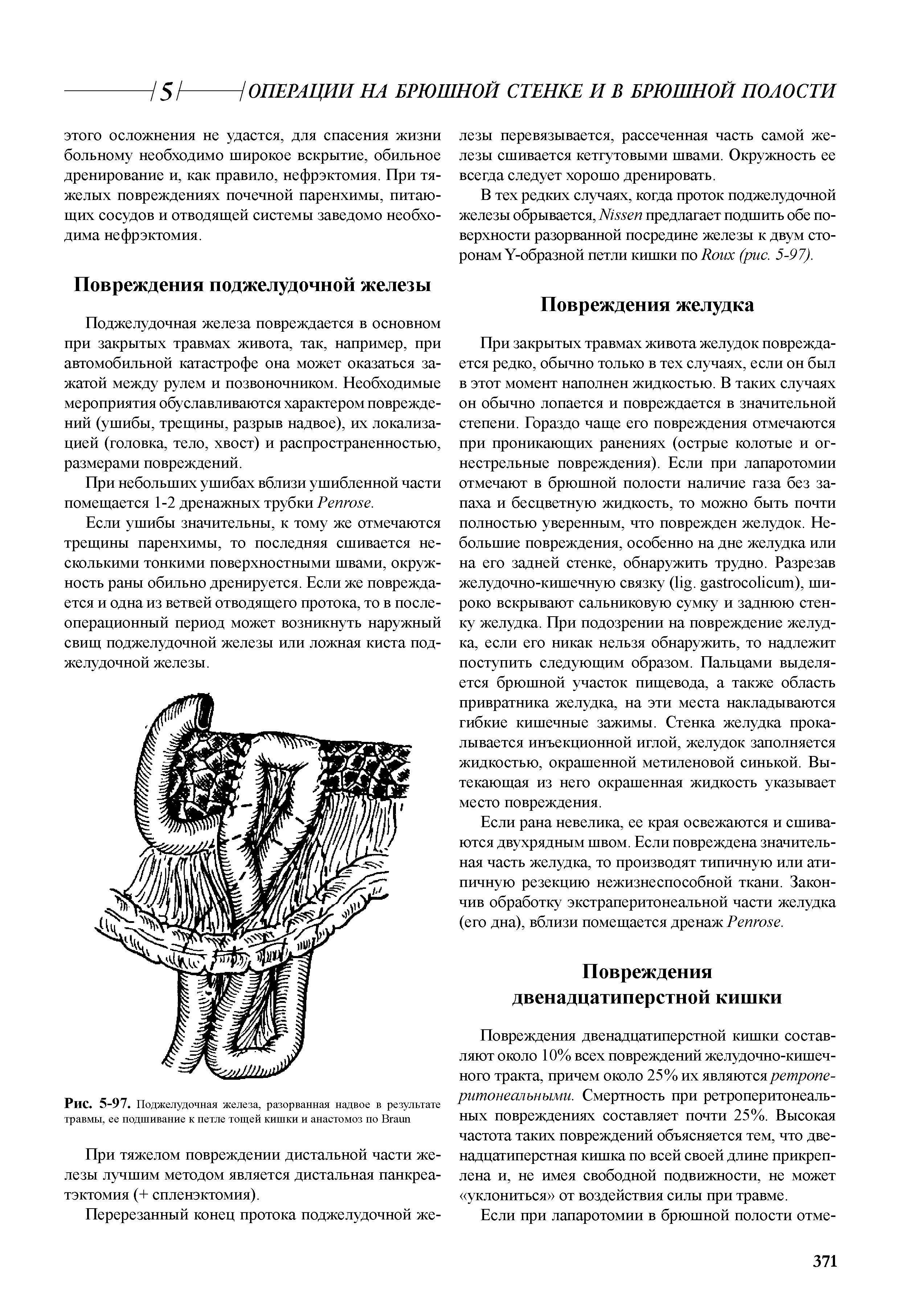 Рис. 5-97. Поджелудочная железа, разорванная надвое в результате травмы, ее подшивание к петле тощей кишки и анастомоз по B ...