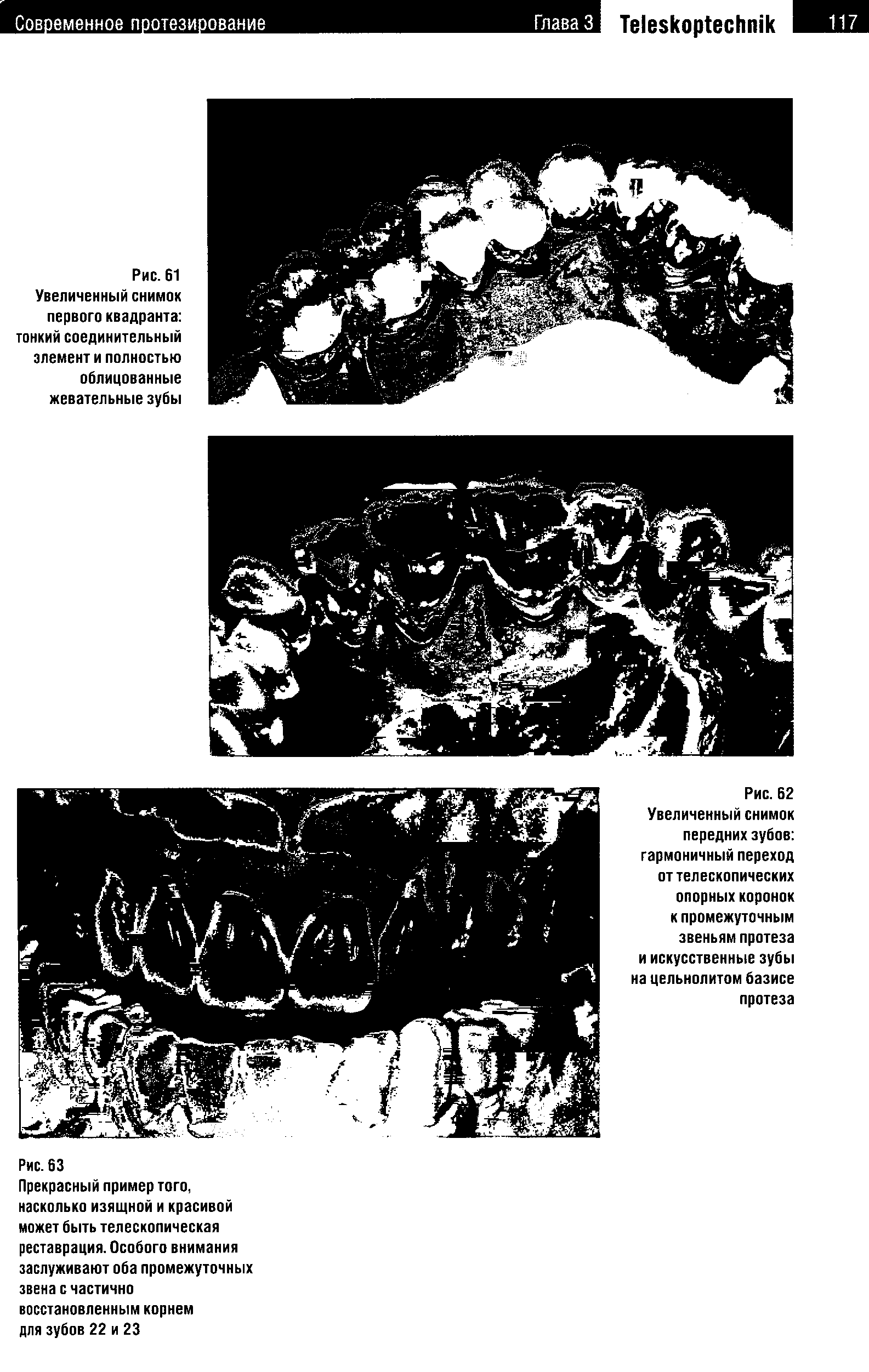 Рис. 62 Увеличенный снимок передних зубов гармоничный переход от телескопических опорных коронок к промежуточным звеньям протеза и искусственные зубы на цельнолитом базисе протеза...