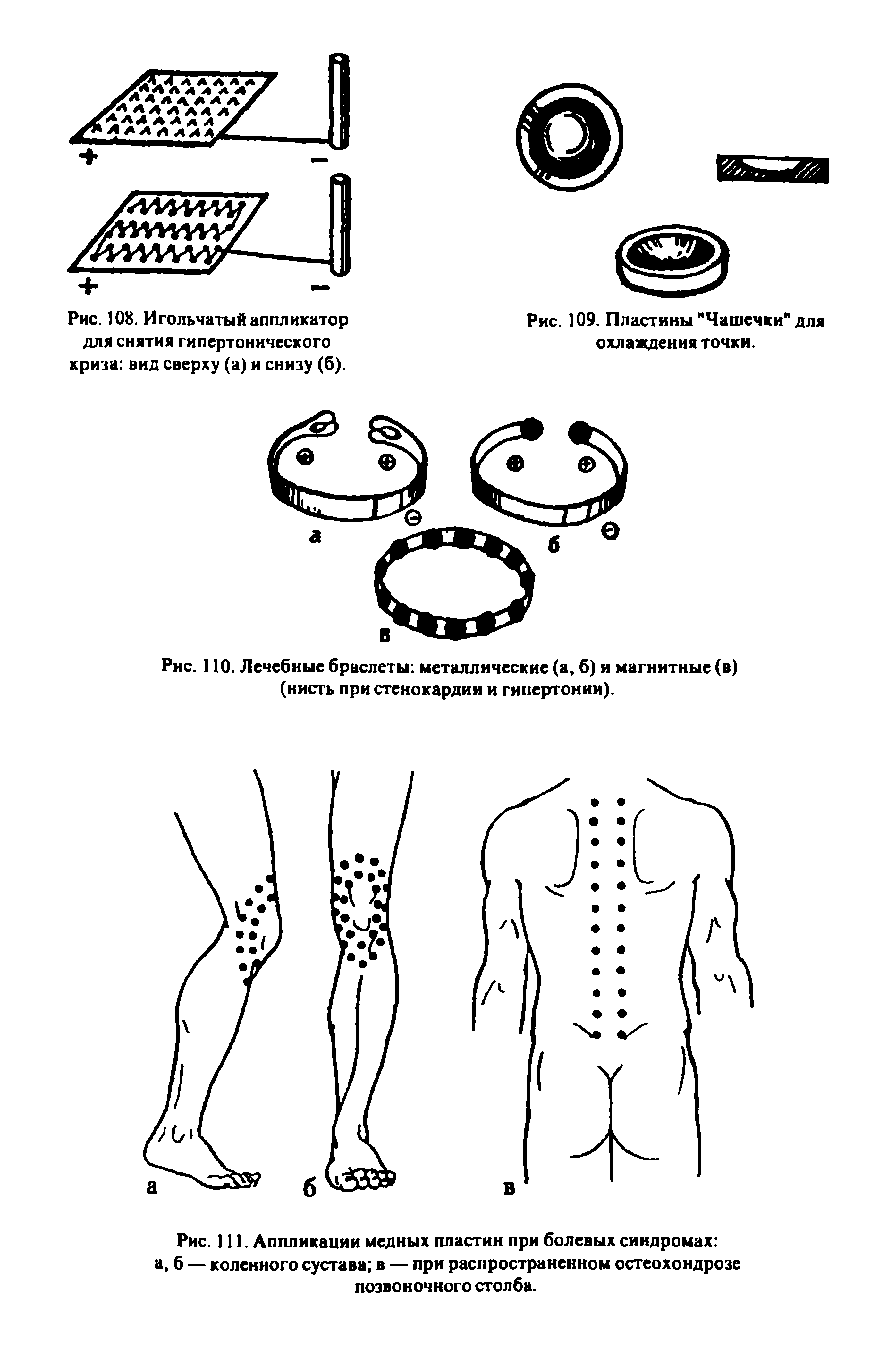 Рис. 111. Аппликации медных пластин при болевых синдромах а, б — коленного сустава в — при распространенном остеохондрозе позвоночного столба.