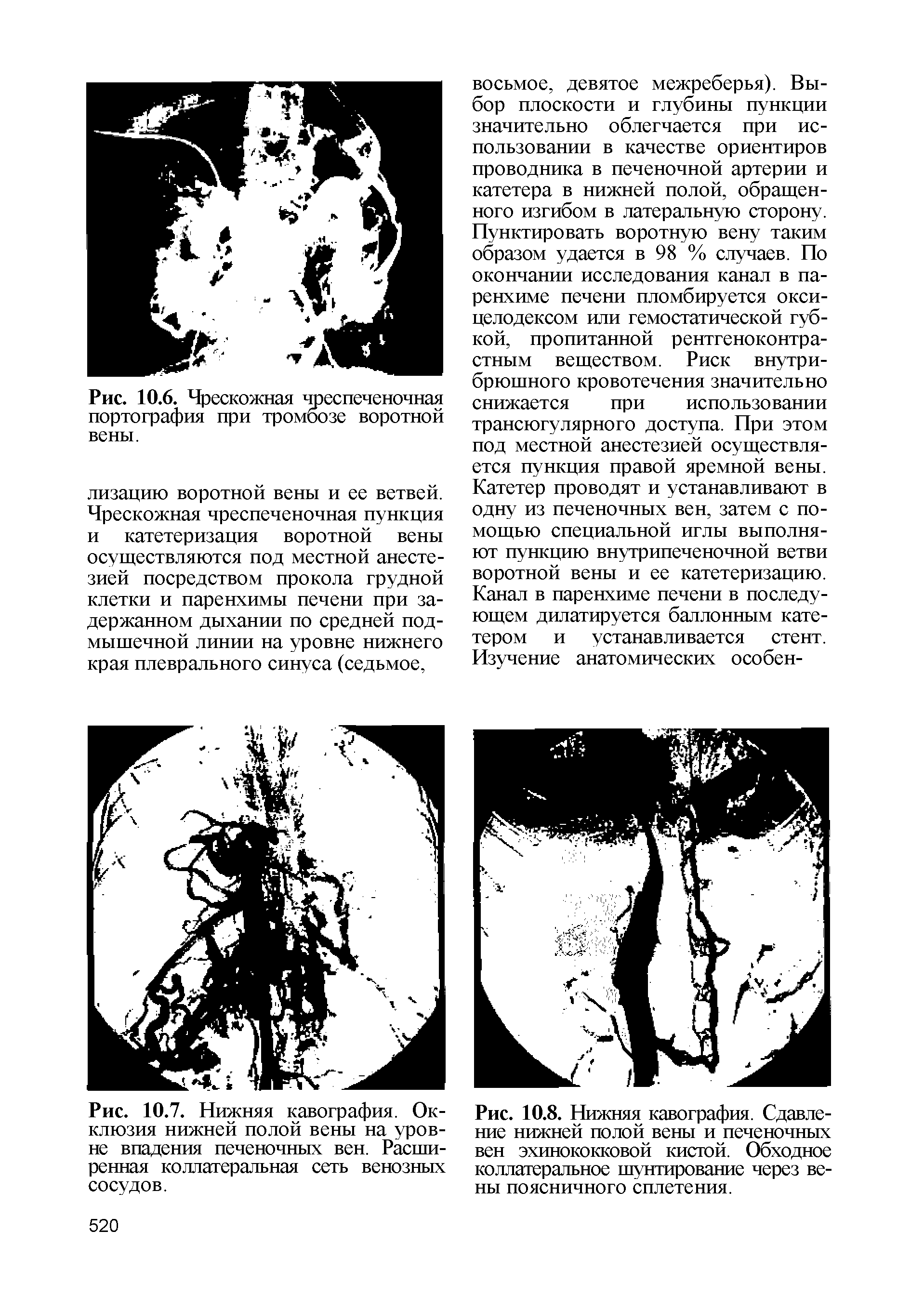 Рис. 10.8. Нижняя кавография. Сдавление нижней полой вены и печеночных вен эхинококковой кистой. Обходное коллатеральное шунтирование через вены поясничного сплетения.