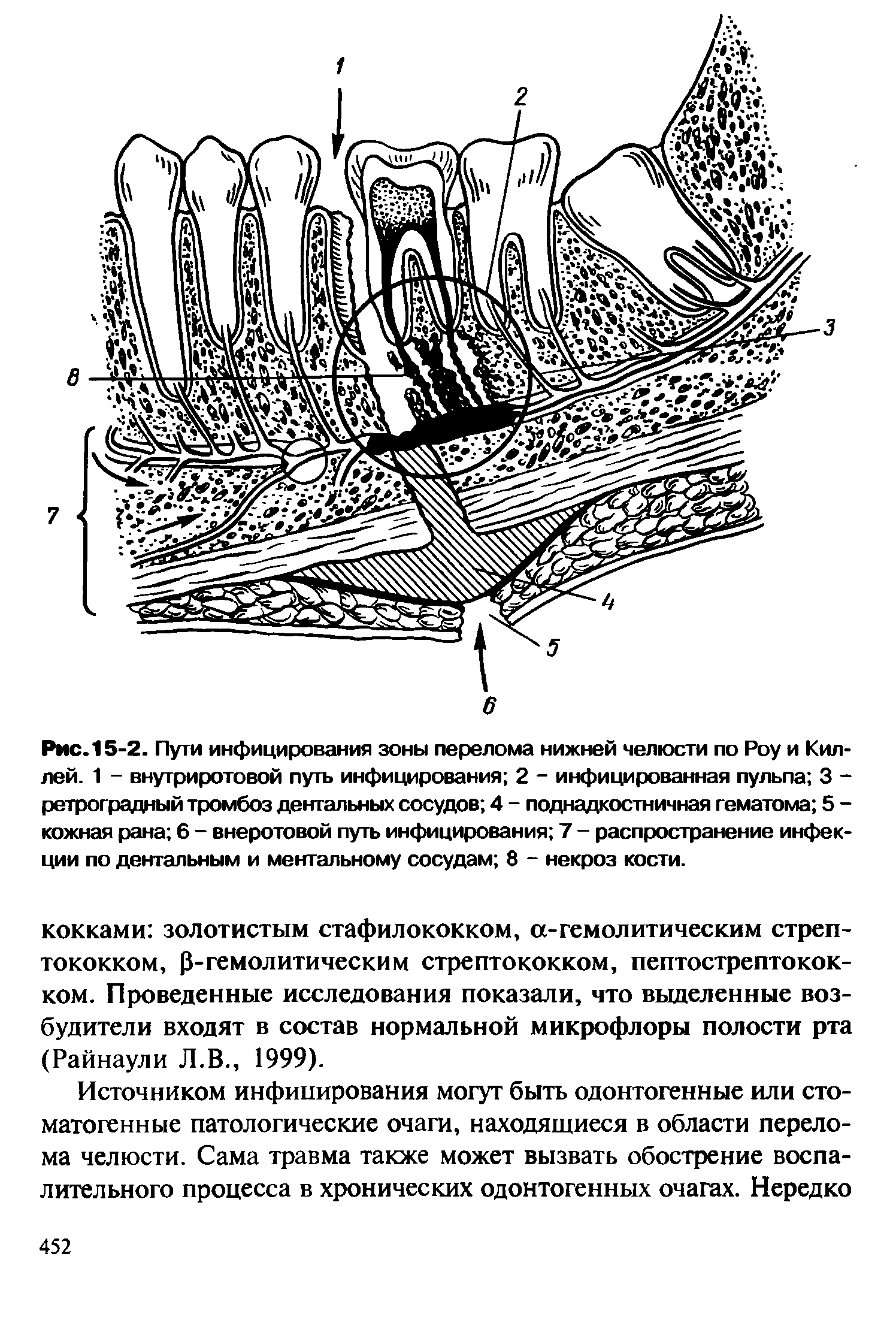 Рис. 15-2. Пути инфицирования зоны перелома нижней челюсти по Роу и Кил-лей. 1 - внутриротовой путь инфицирования 2 - инфицированная пульпа 3 -ретроградный тромбоз дентальных сосудов 4 - поднадкостничная гематома 5 -кожная рана 6 - внеротовой путь инфицирования 7 - распространение инфекции по дентальным и ментальному сосудам 8 - некроз кости.