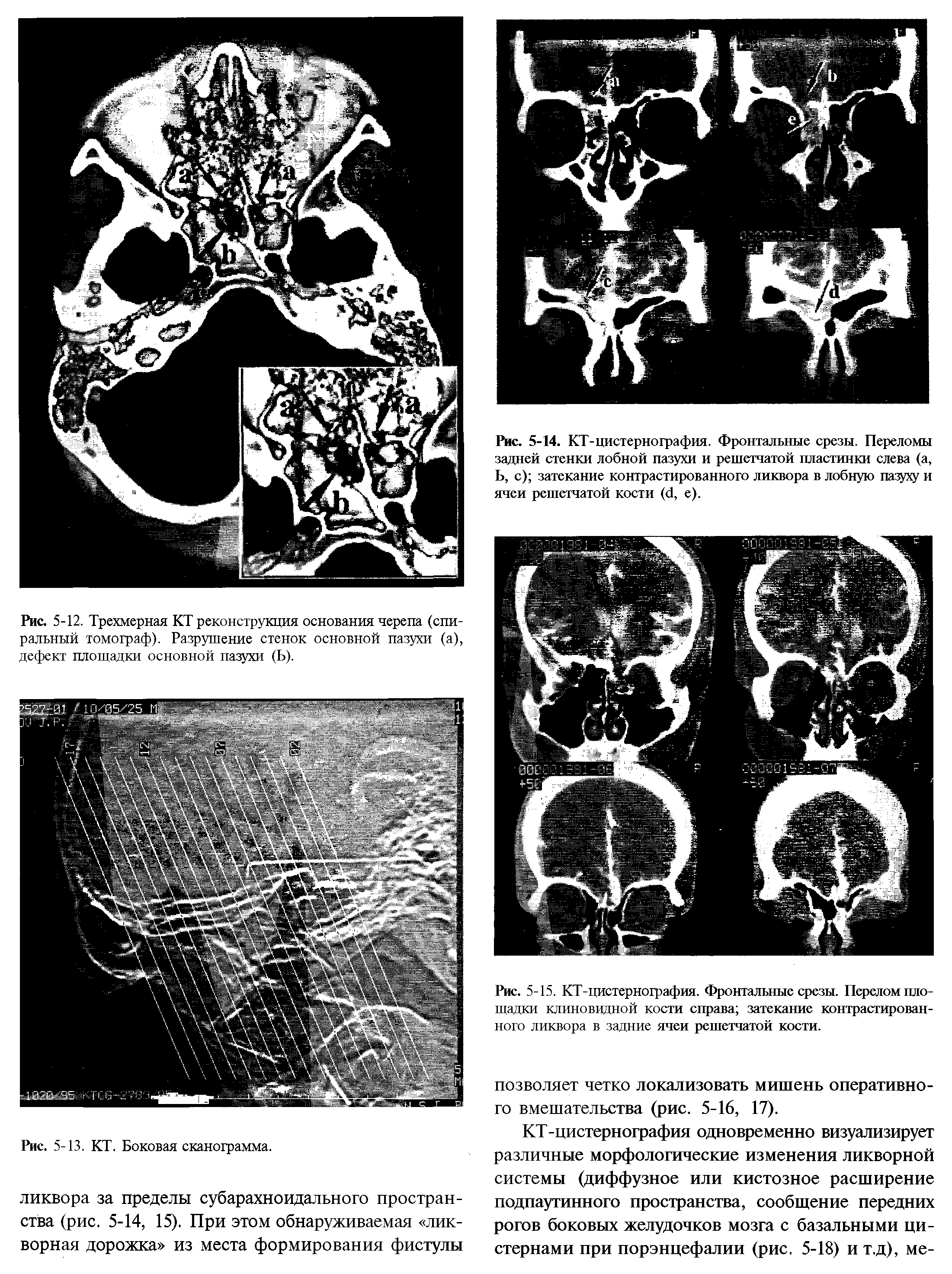 Рис. 5-14. КТ-цистернография. Фронтальные срезы. Переломы задней стенки лобной пазухи и решетчатой пластинки слева (а, Ь, с) затекание контрастированного ликвора в лобную пазуху и ячеи решетчатой кости (Д, е).