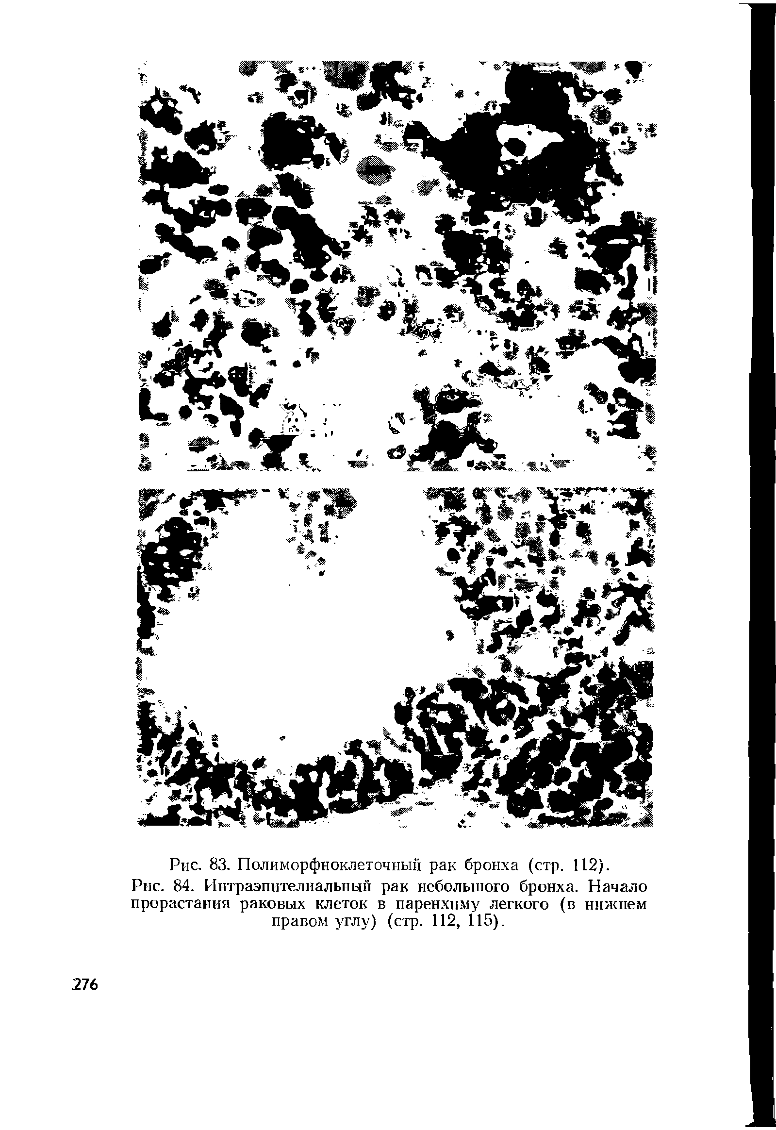 Рис. 84. Интраэпителиальный рак небольшого бронха. Начало прорастания раковых клеток в паренхиму легкого (в нижнем правом углу) (стр. 112, 115).