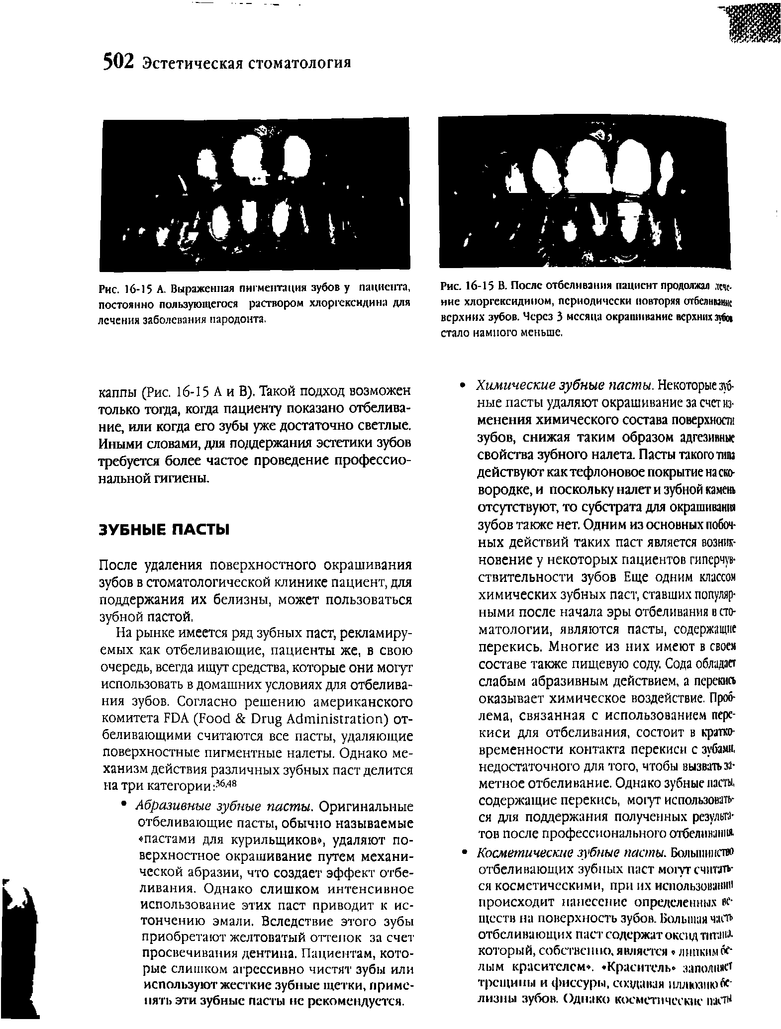 Рис. 16-15 А. Выраженная пигментация зубов у пациента, постоянно пользующегося раствором хлоргексидина для лечения заболевания пародонта.