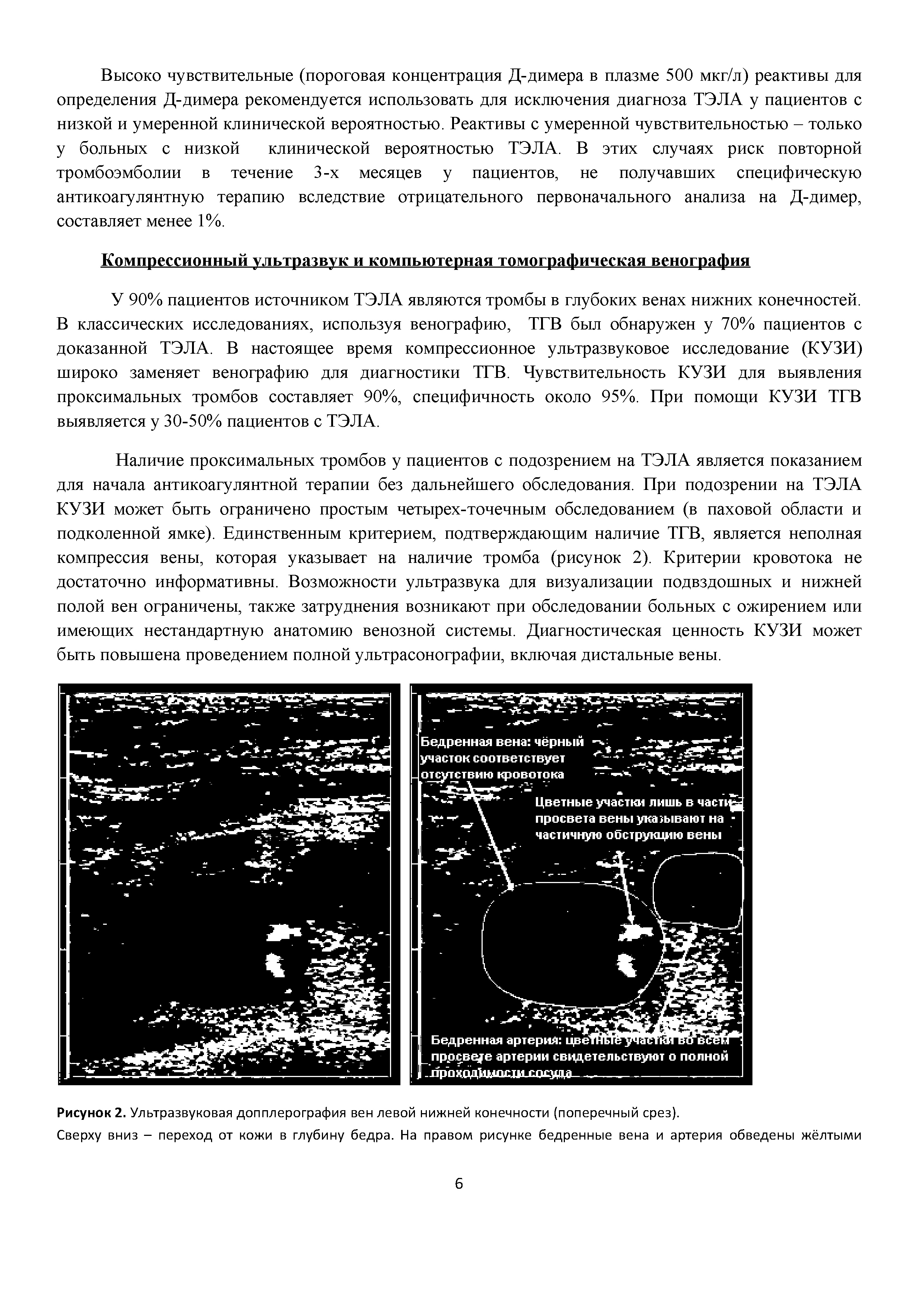 Рисунок 2. Ультразвуковая допплерография вен левой нижней конечности (поперечный срез).