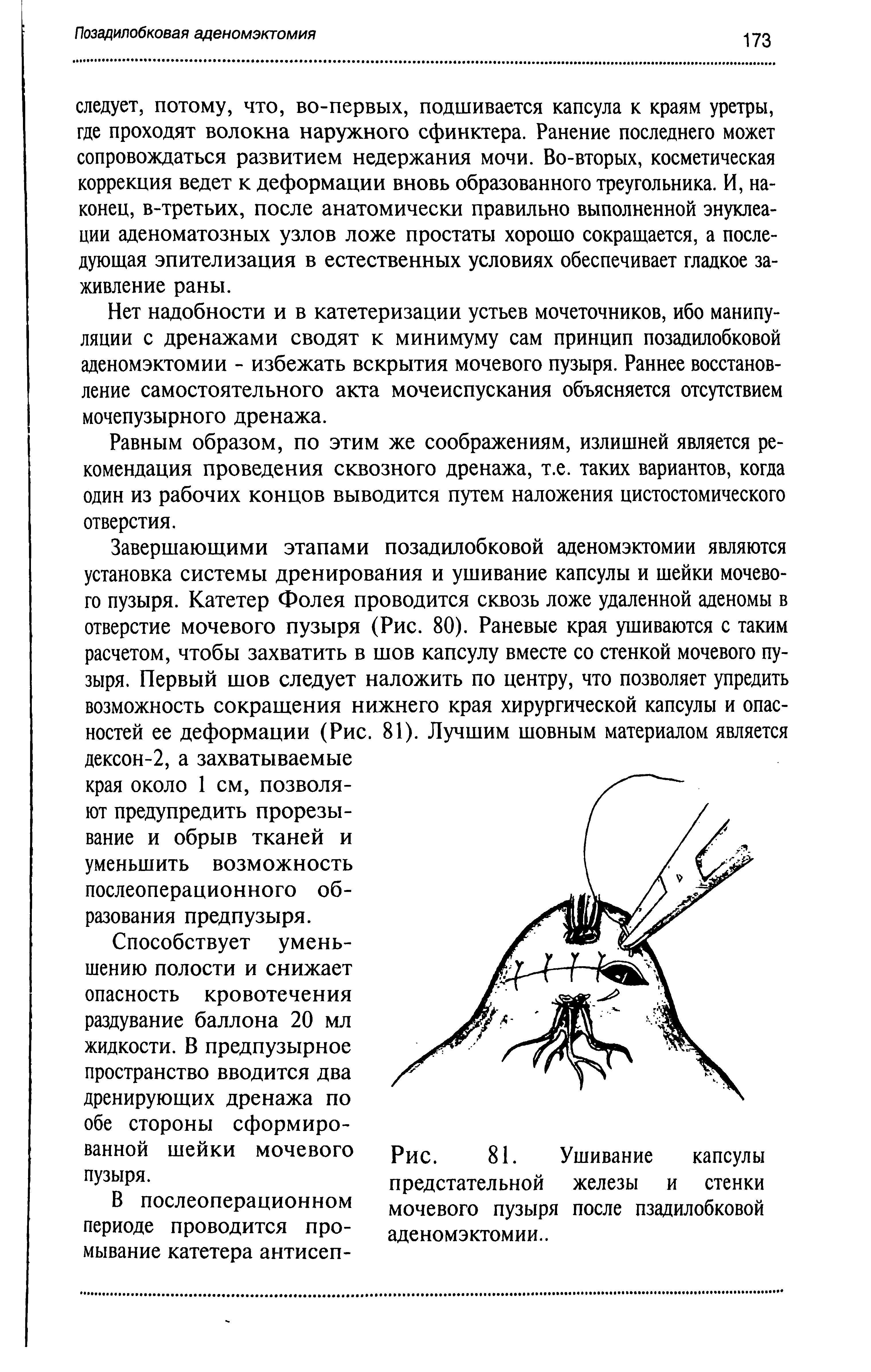 Рис. 81. Ушивание капсулы предстательной железы и стенки мочевого пузыря после пзадилобковой аденомэктомии..