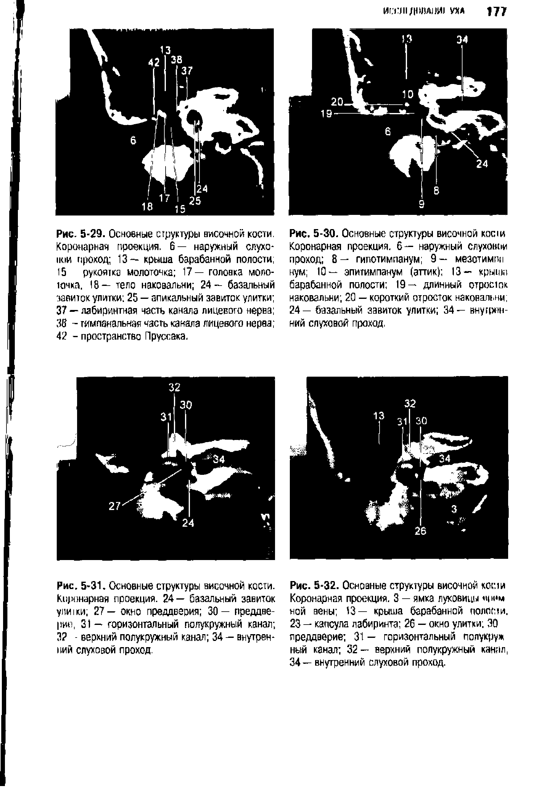 Рис. 5-32. Основные структуры височной косии Коронарная проекция. 3 — ямка луковицы ной вены 13— крыша барабанной полости, 23 — капсула лабиринта 26 — окно улитки 30 преддверие 31 — горизонтальный полукруж ный канал 32 — верхний полукружный канал 34— внутренний слуховой проход.