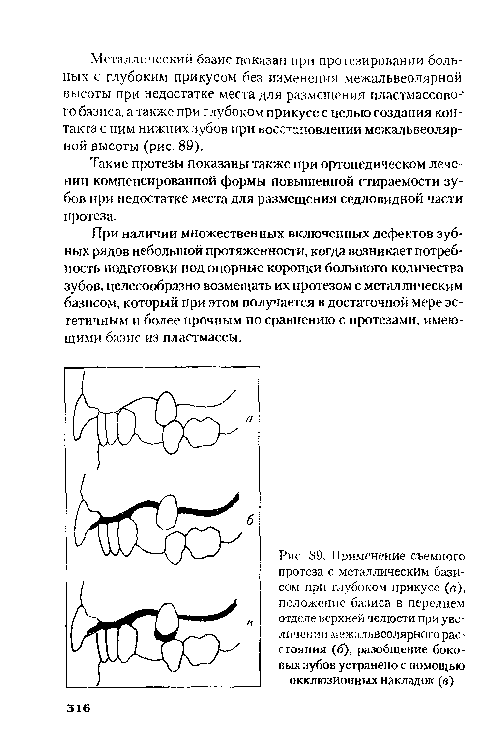 Рис. 89. Применение съемного протеза с металлическим базисом при глубоком прикусе (< ), положение базиса в переднем отделе верхней челюсти при увеличении межальвеолярного расстояния (б), разобщение боковых зубов устранено с помощью окклюзионных накладок (в)...