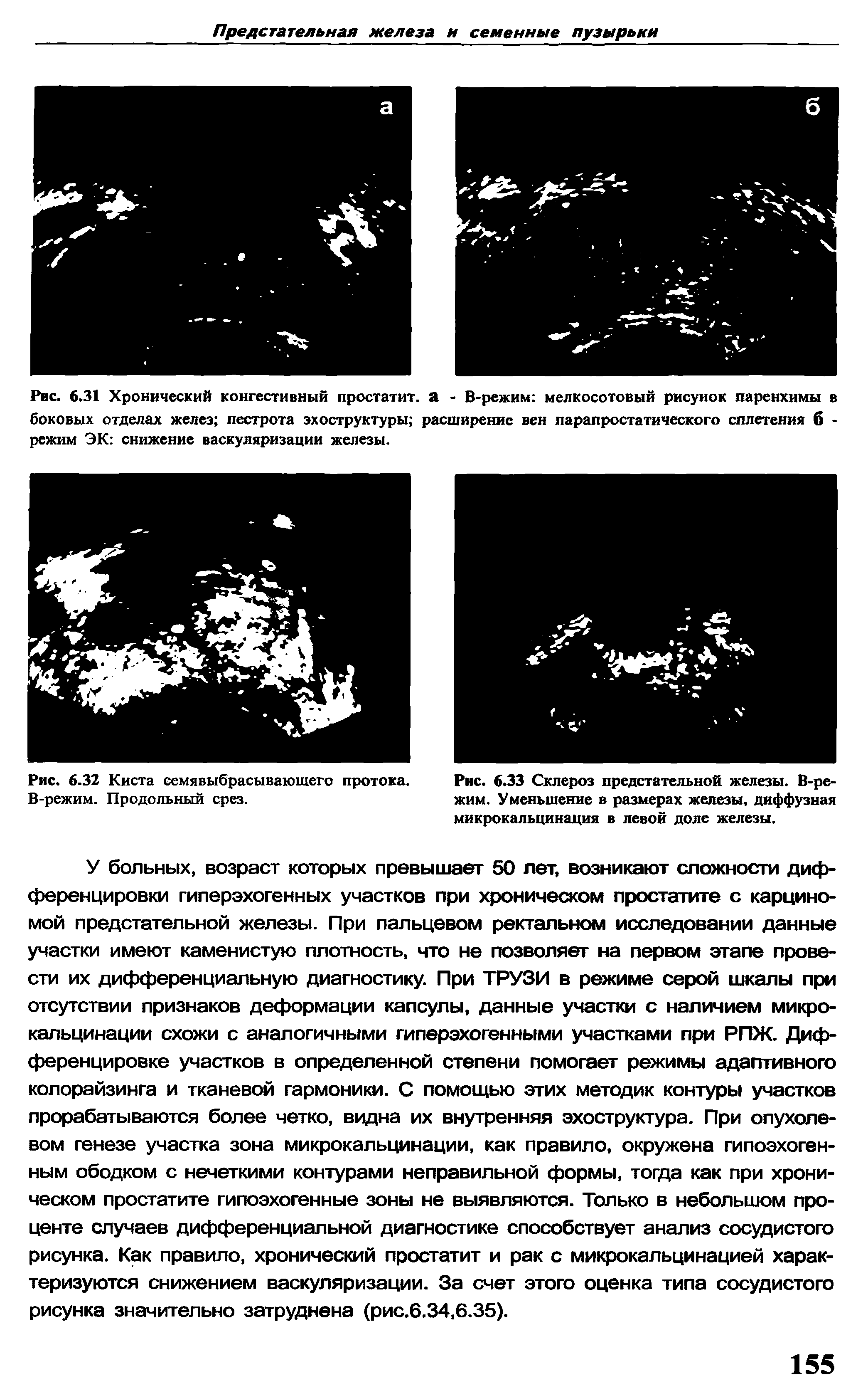 Рис. 6.31 Хронический конгестивный простатит, а - В-режим мелкосотовый рисунок паренхимы в боковых отделах желез пестрота эхоструктуры расширение вен парапростатического сплетения б -режим ЭК снижение васкуляризации железы.