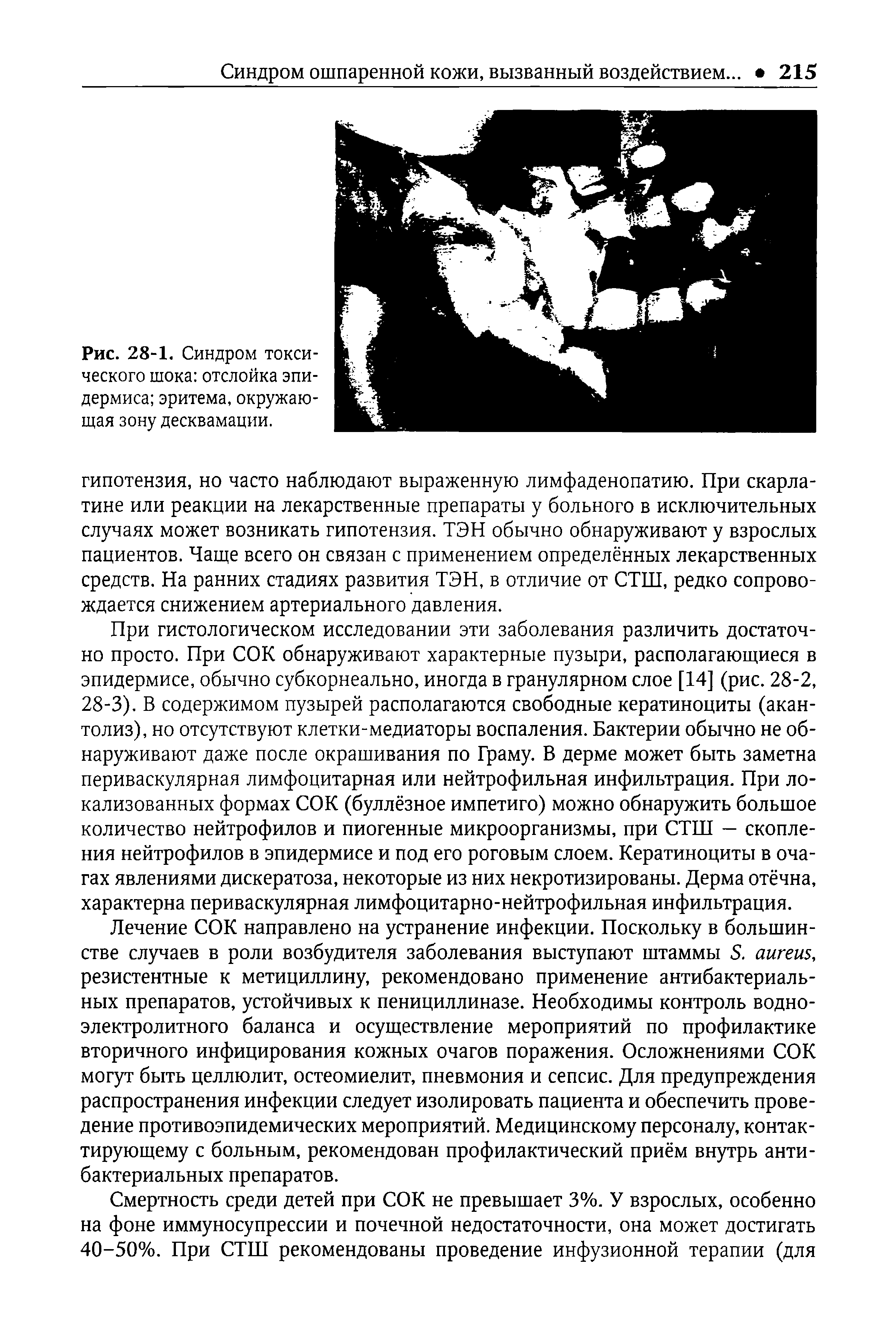 Рис. 28-1. Синдром токсического шока отслойка эпидермиса эритема, окружающая зону десквамации.