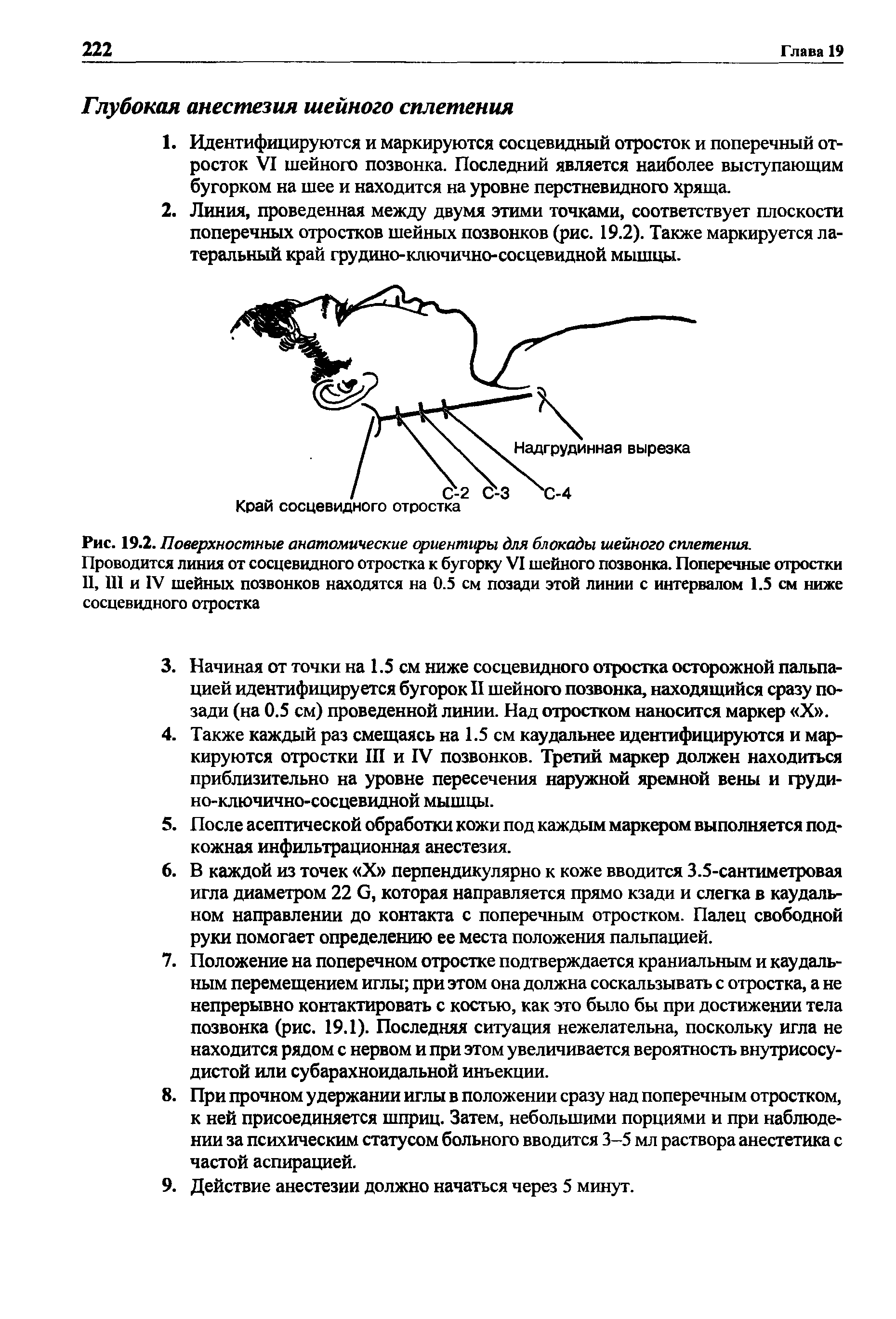 Рис. 19.2. Поверхностные анатомические ориентиры для блокады шейного сплетения. Проводится линия от сосцевидного отростка к бугорку VI шейного позвонка. Поперечные отростки II, III и IV шейных позвонков находятся на 0.5 см позади этой линии с интервалом 1.5 см ниже сосцевидного отростка...