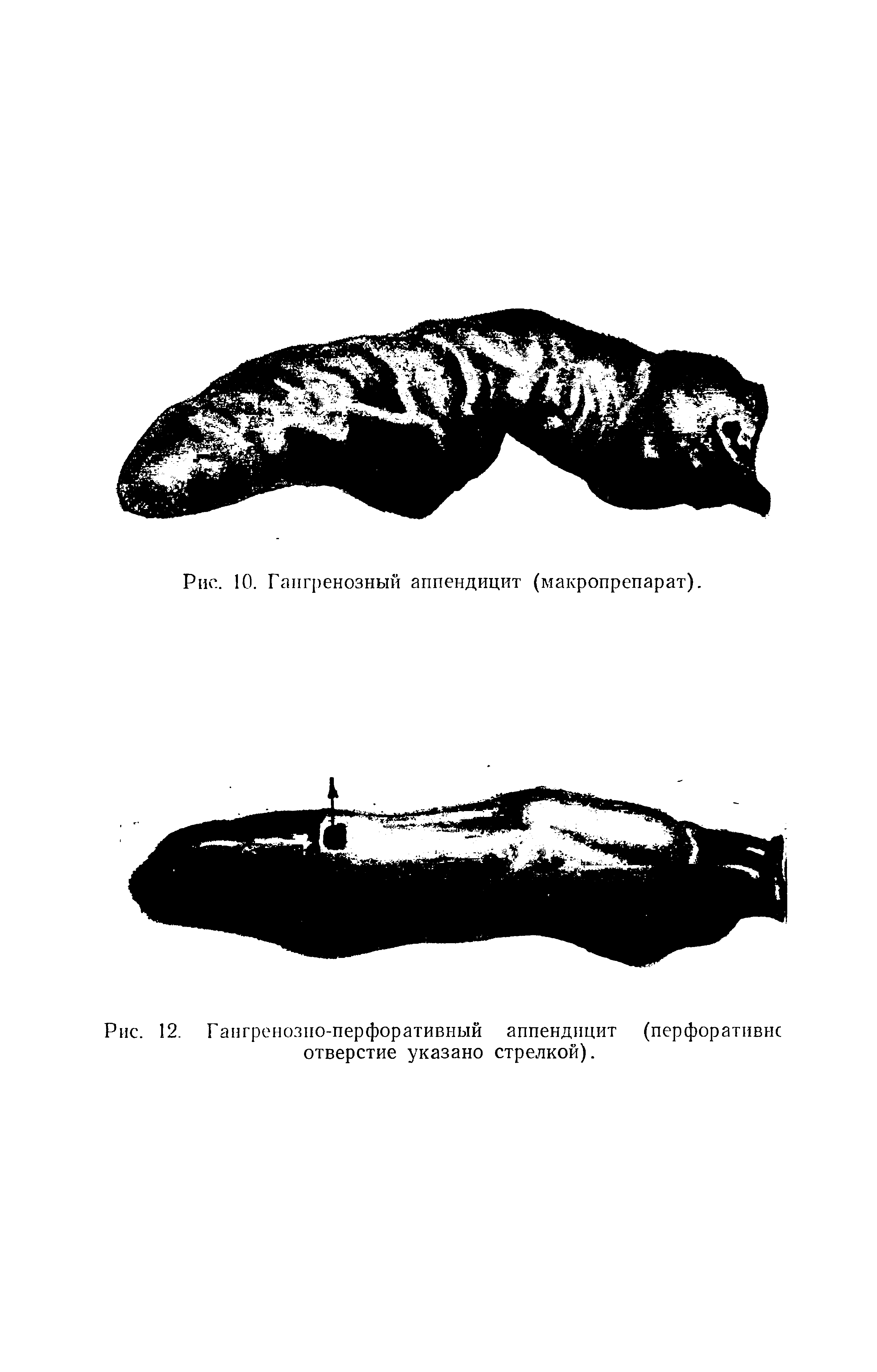 Рис. 12. Гангренозно-перфоративный аппендицит (перфоративнс отверстие указано стрелкой).